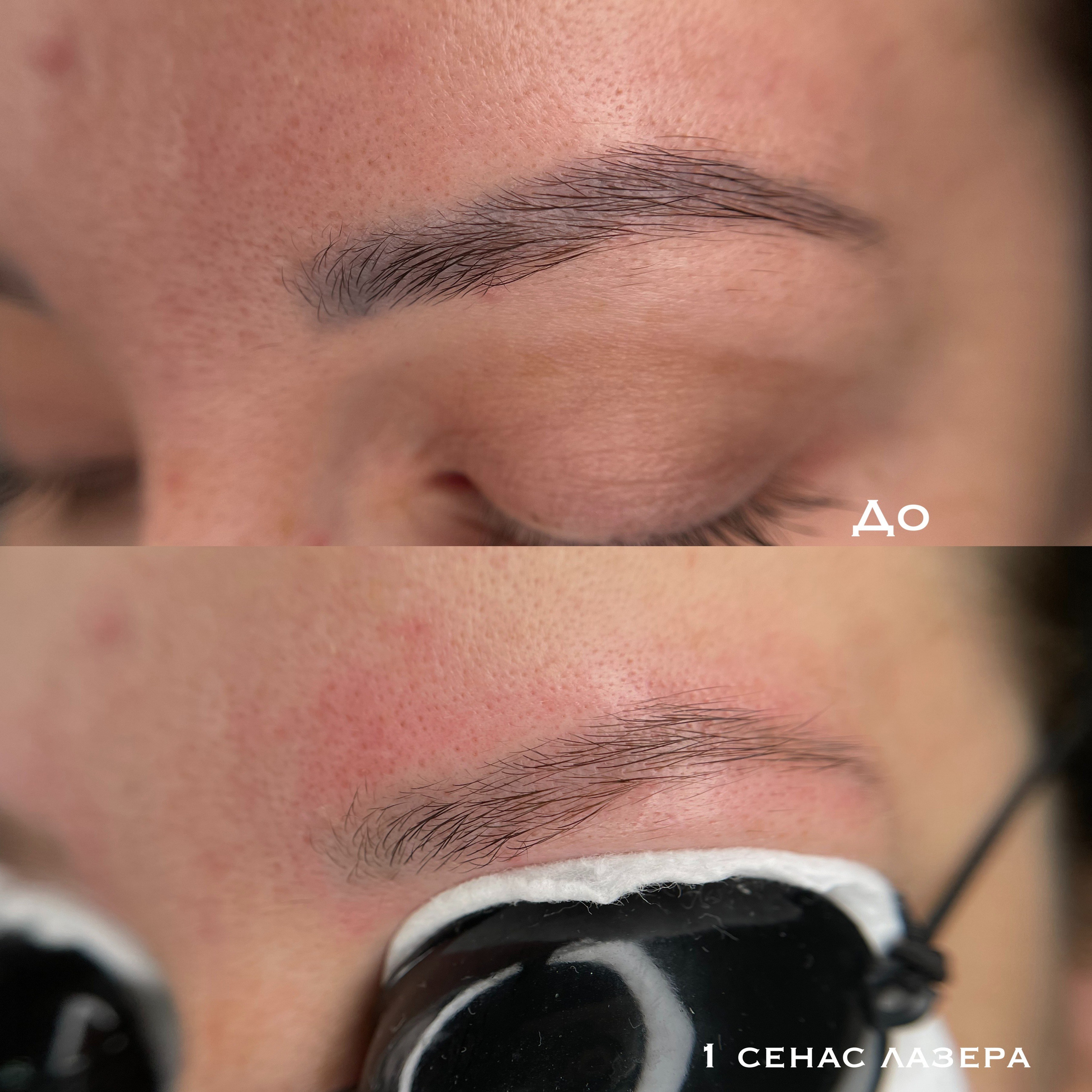 УДАЛЕНИЕ СТАРОГО ТАТУАЖА. Перманентный макияж и удаление старого татуажа в Ростове-на-Дону Дарья Исакова