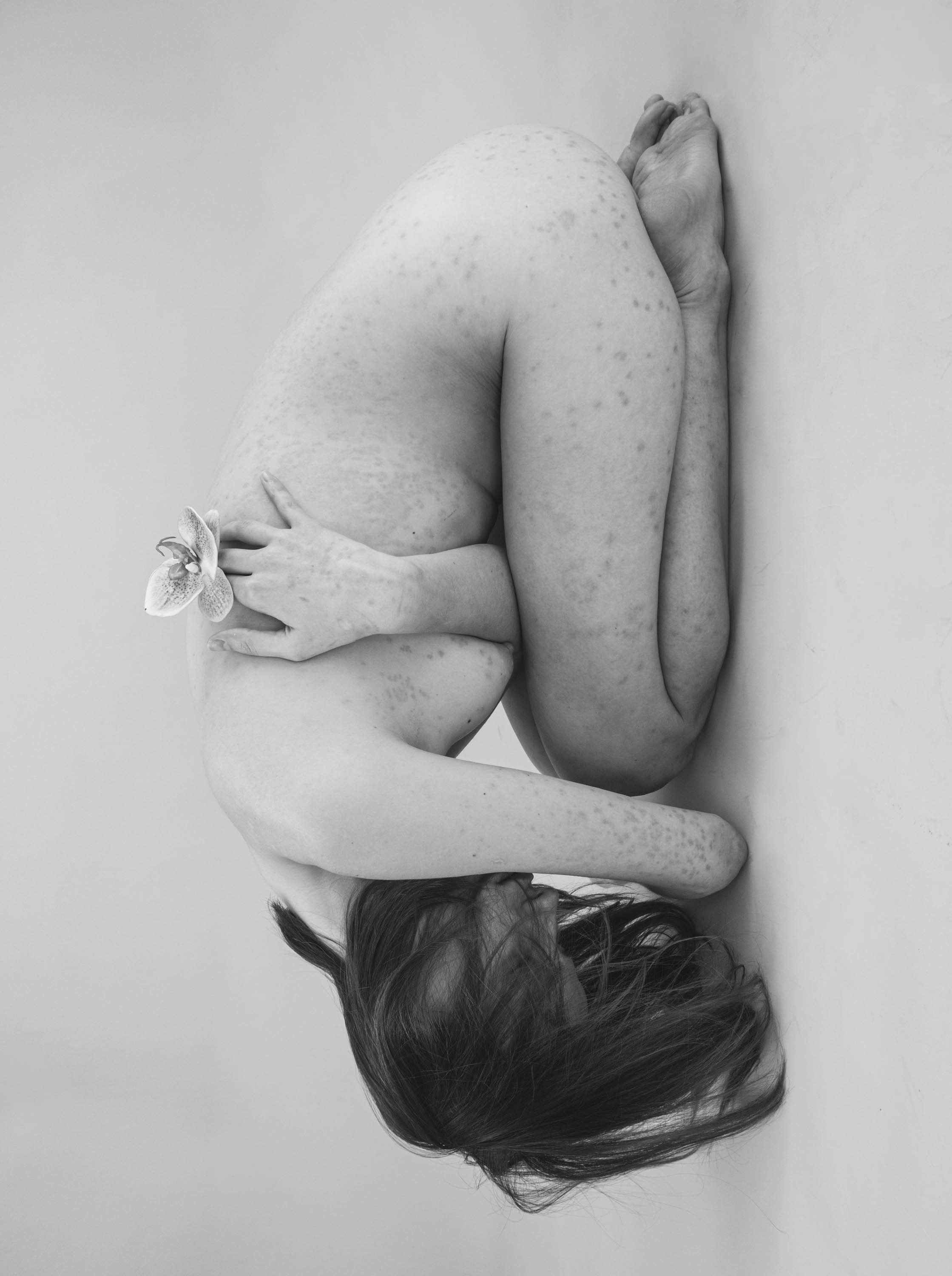 псориаз на женском теле фотосъемка показывает красоту индивидуальности 