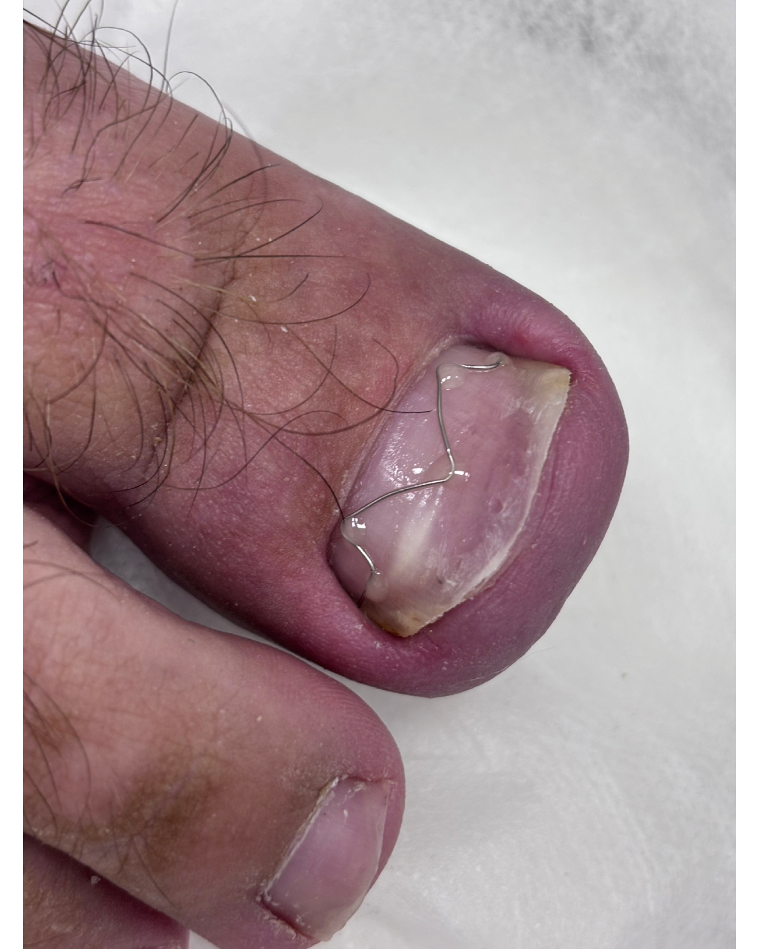 Вросший ноготь. Подолог г. Хабаровск — центр здоровой стопы «FOOTTIME»