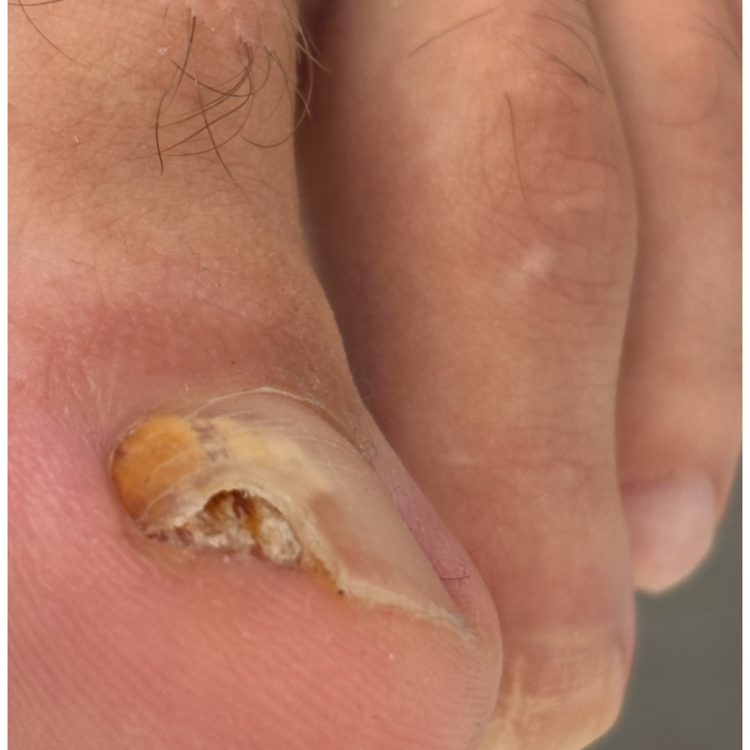 Динамика онихомикоз. Подолог г. Хабаровск — центр здоровой стопы «FOOTTIME»