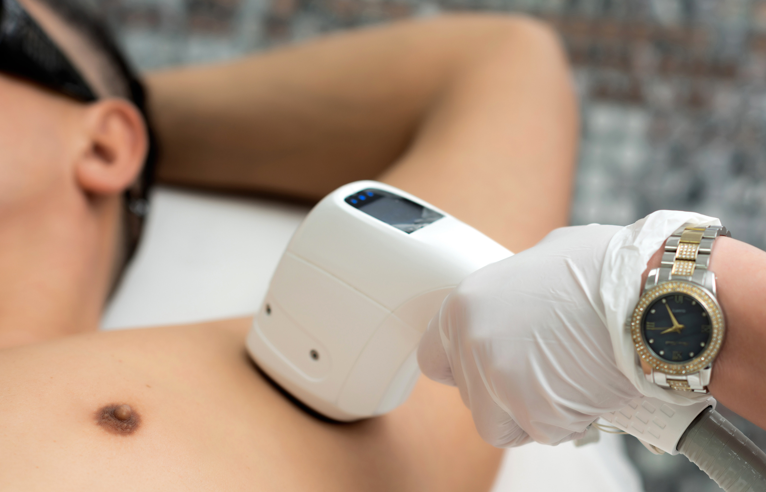 Лазерная эпиляция в г. Кемерово, г. Новокузнецке и г. Киселевске