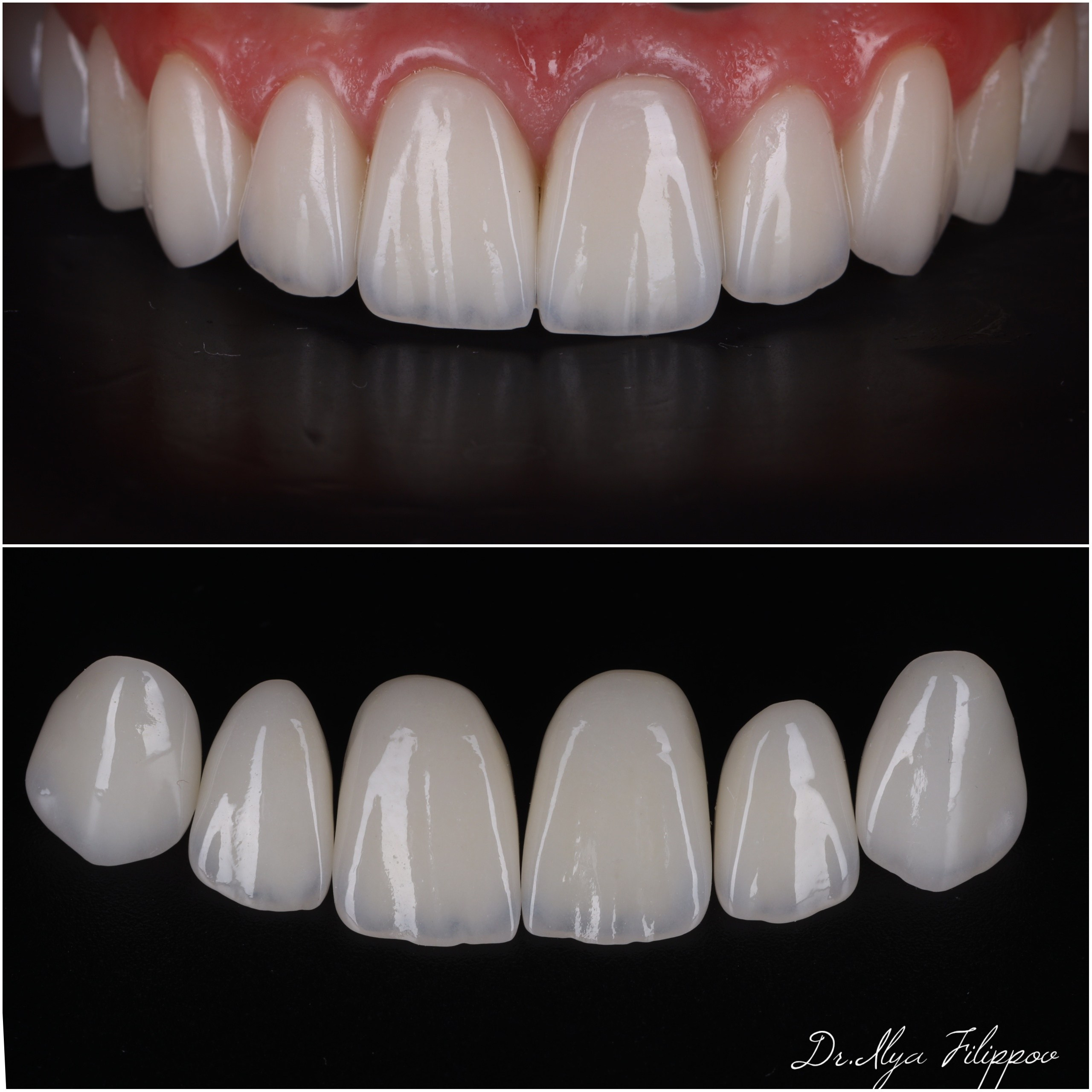 Стоматология в Твери - Линия Улыбки Коронки. Стоматология в Твери - Линия Улыбки