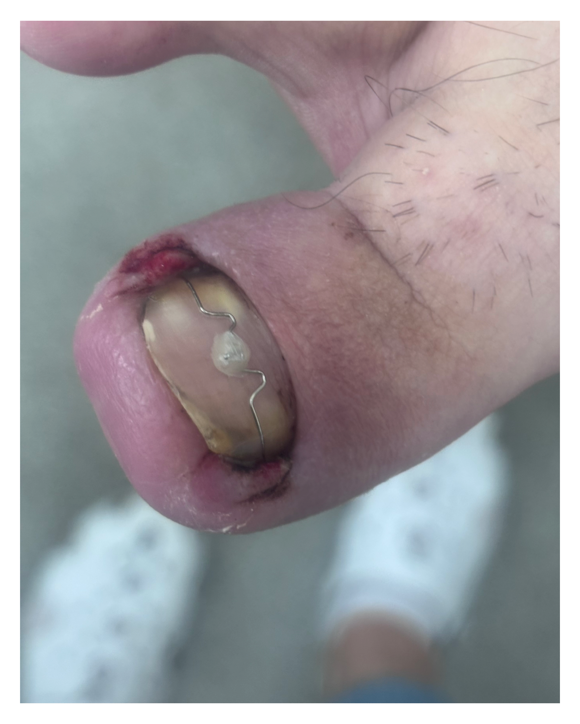 Вросший ноготь. Подолог г. Хабаровск — центр здоровой стопы «FOOTTIME»