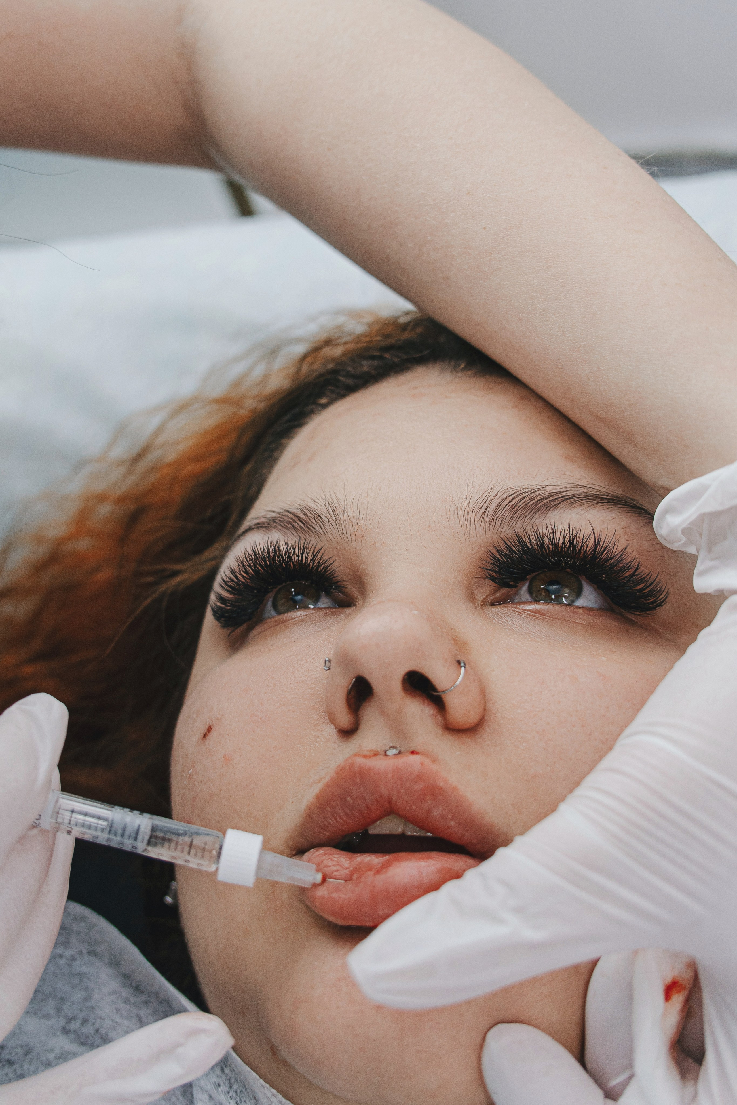 Пациентка лежит на кушетке, косметолог делает укол в губы с использованием местной анестезии