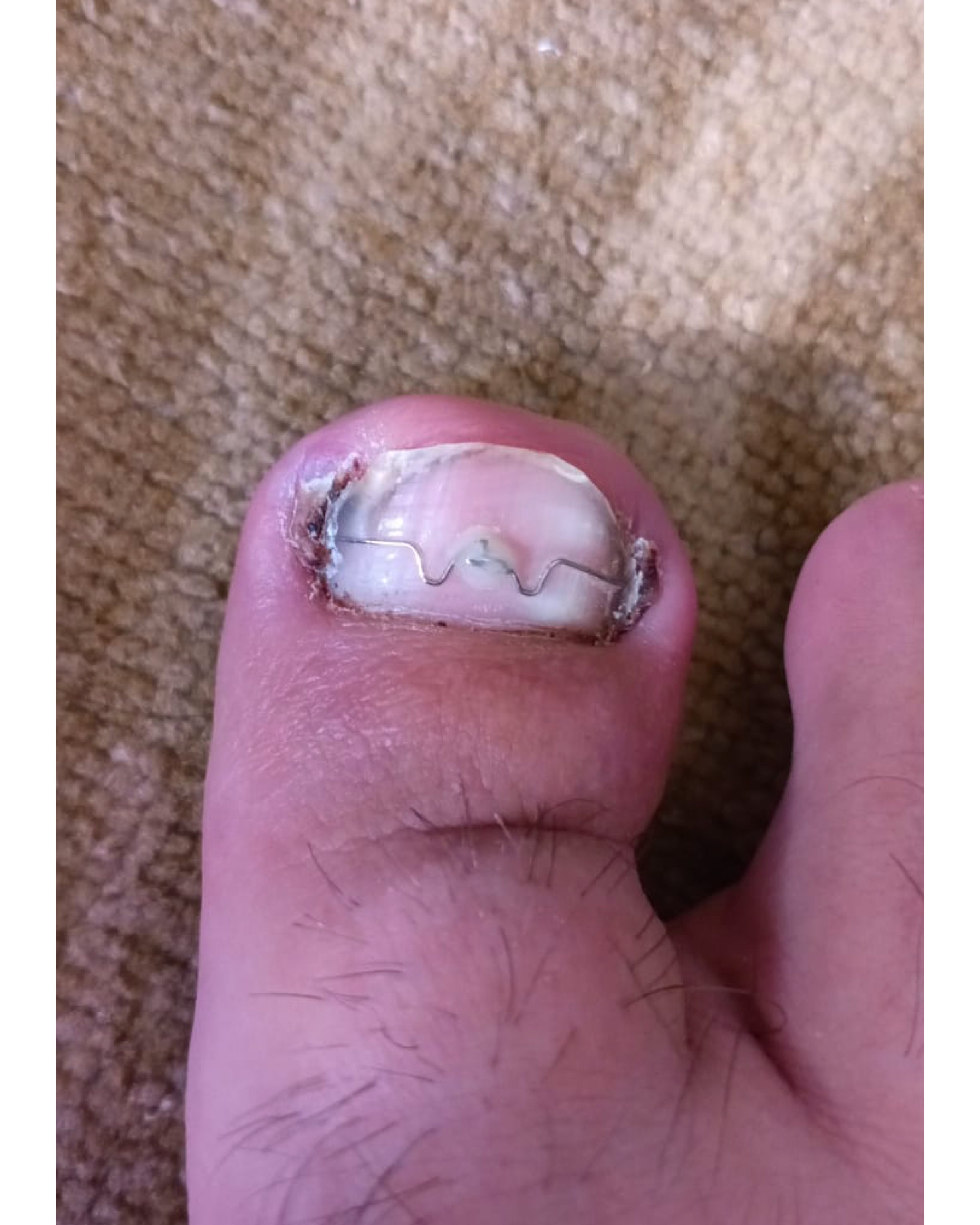 Вросший ноготь. Подолог г. Хабаровск — центр здоровой стопы «FOOTTIME»