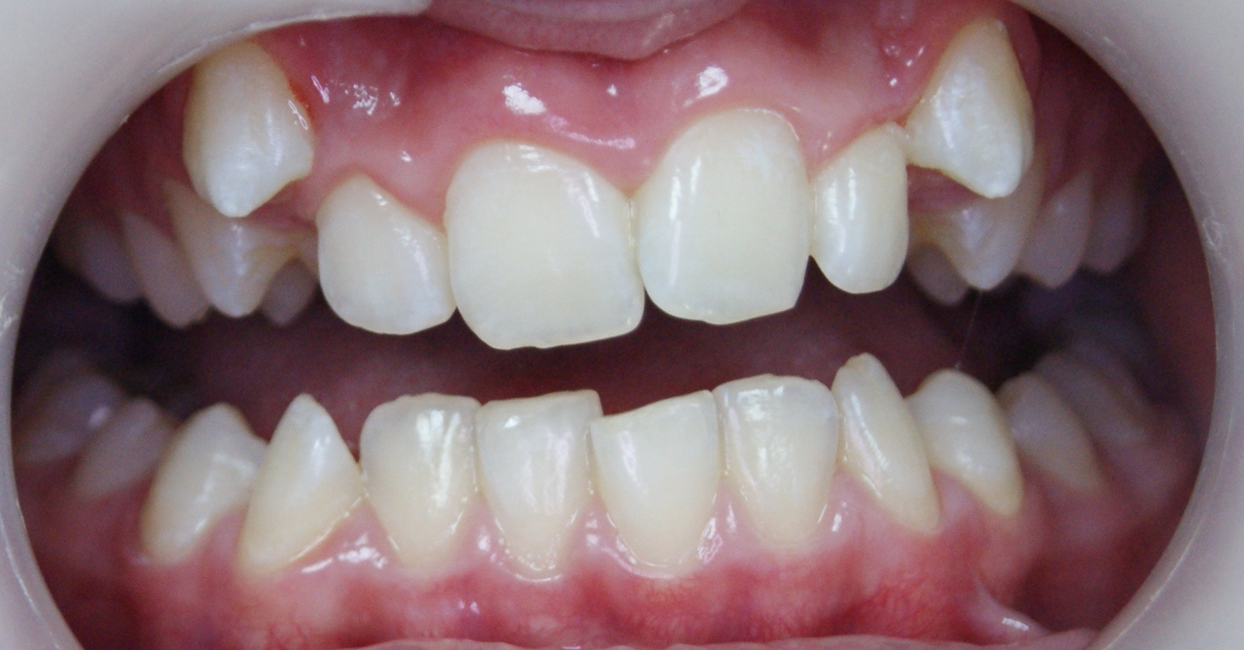 Результаты работ до/после и замечательные улыбки. Стоматология «Ортодонт-Эстетик». Установка брекетов в Оренбурге, взрос