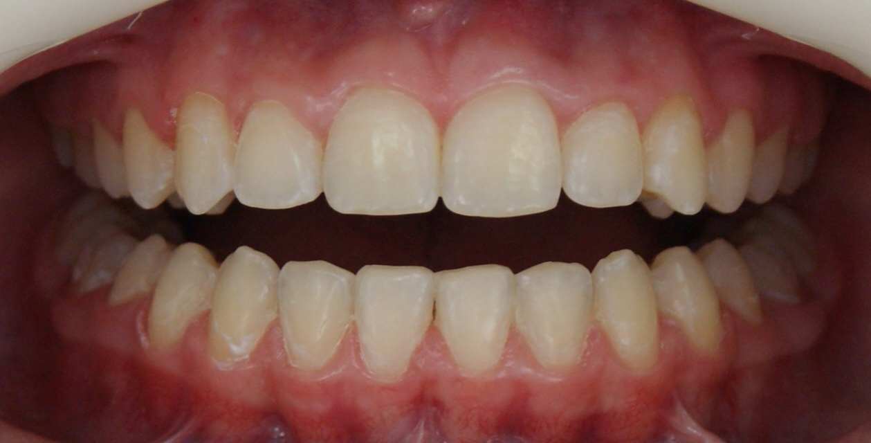 Результаты работ до/после и замечательные улыбки. Стоматология «Ортодонт-Эстетик». Установка брекетов в Оренбурге, взрос