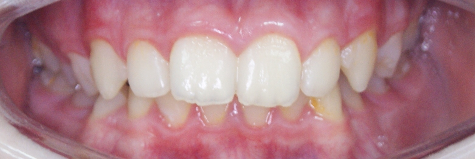 Результаты работ до/после и замечательные улыбки. Стоматология «Ортодонт-Эстетик». Установка брекетов в Оренбурге, взрос