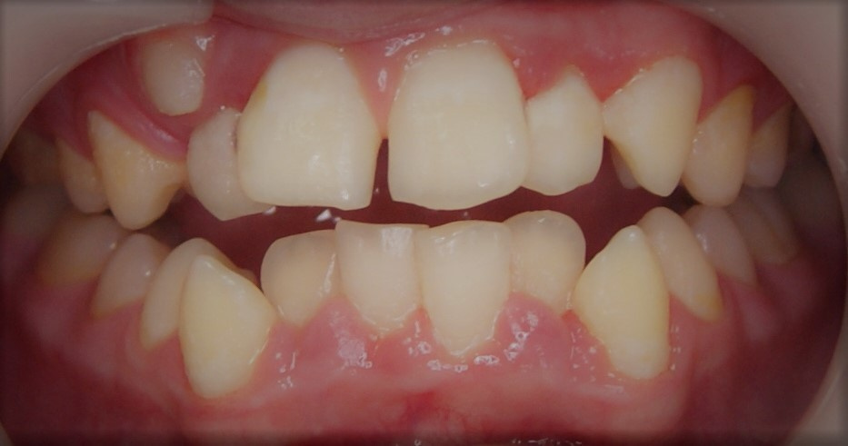 Результаты работ до/после и замечательные улыбки. Стоматология «Ортодонт-Эстетик». Установка брекетов в Оренбурге, взрос