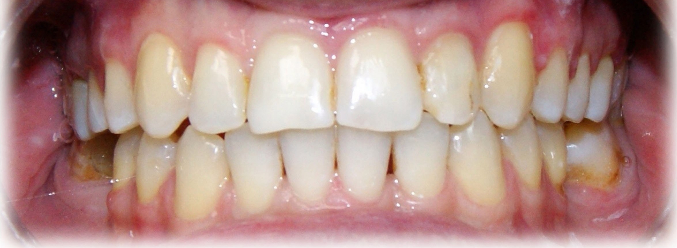 Результаты работ до/после и замечательные улыбки. Стоматология «Ортодонт-Эстетик». Установка брекетов в Оренбурге, взрос