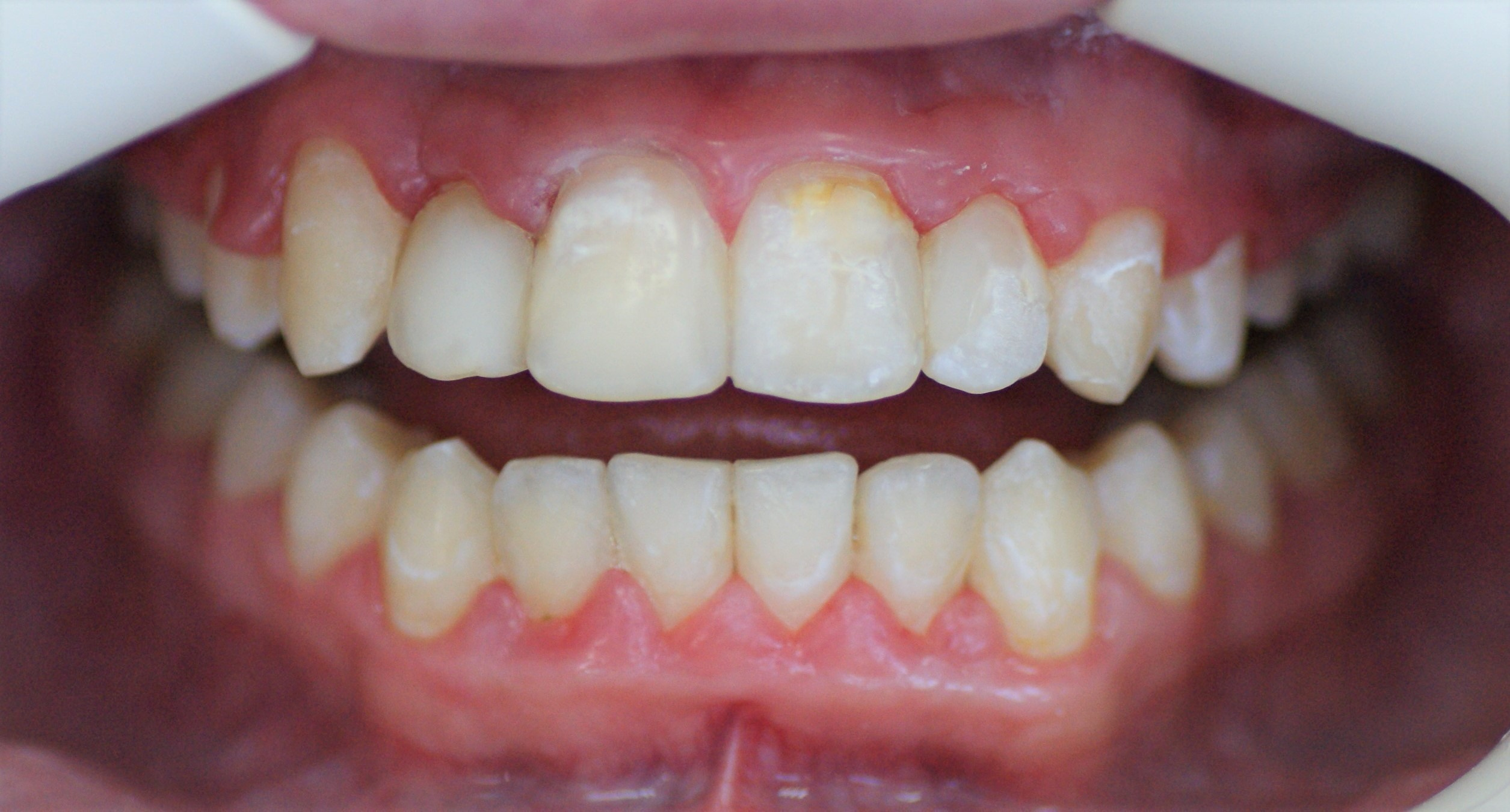 Результаты работ до/после и замечательные улыбки. Стоматология «Ортодонт-Эстетик». Установка брекетов в Оренбурге, взрос