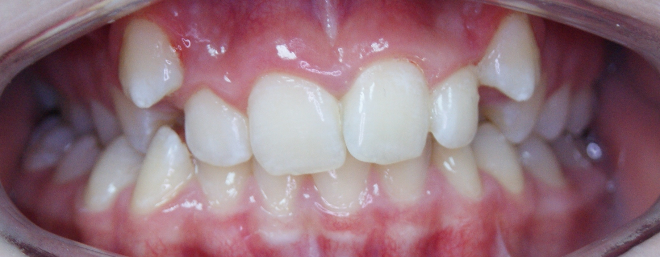 Результаты работ до/после и замечательные улыбки. Стоматология «Ортодонт-Эстетик». Установка брекетов в Оренбурге, взрос