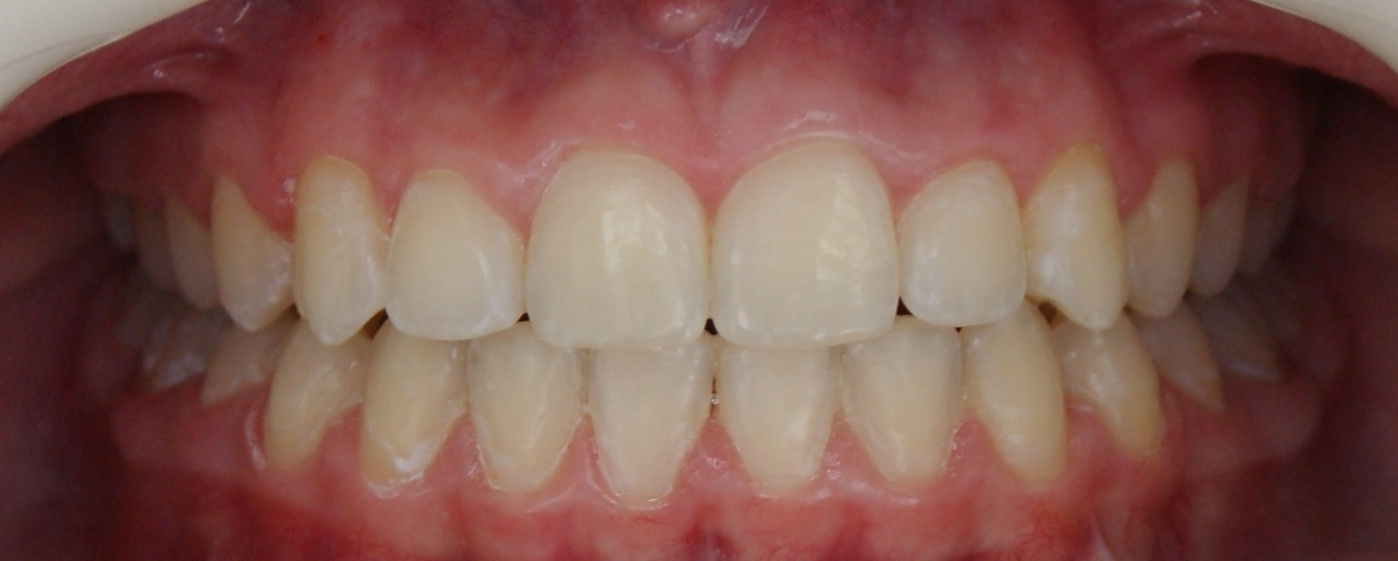 Результаты работ до/после и замечательные улыбки. Стоматология «Ортодонт-Эстетик». Установка брекетов в Оренбурге, взрос