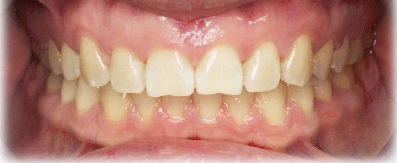 Результаты работ до/после и замечательные улыбки. Стоматология «Ортодонт-Эстетик». Установка брекетов в Оренбурге, взрос