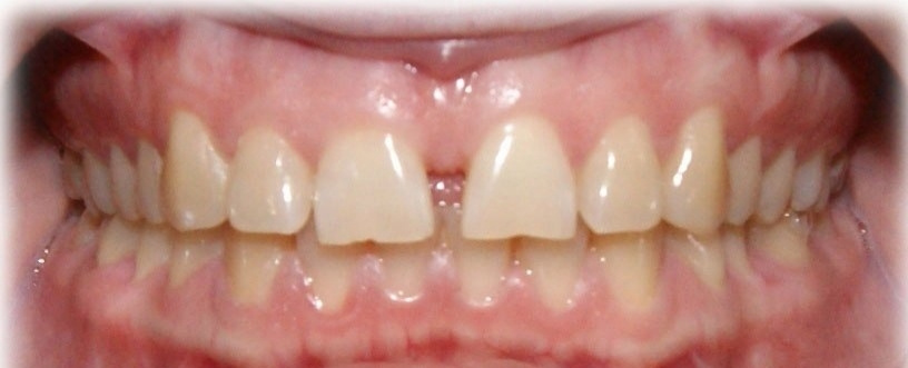 Результаты работ до/после и замечательные улыбки. Стоматология «Ортодонт-Эстетик». Установка брекетов в Оренбурге, взрос