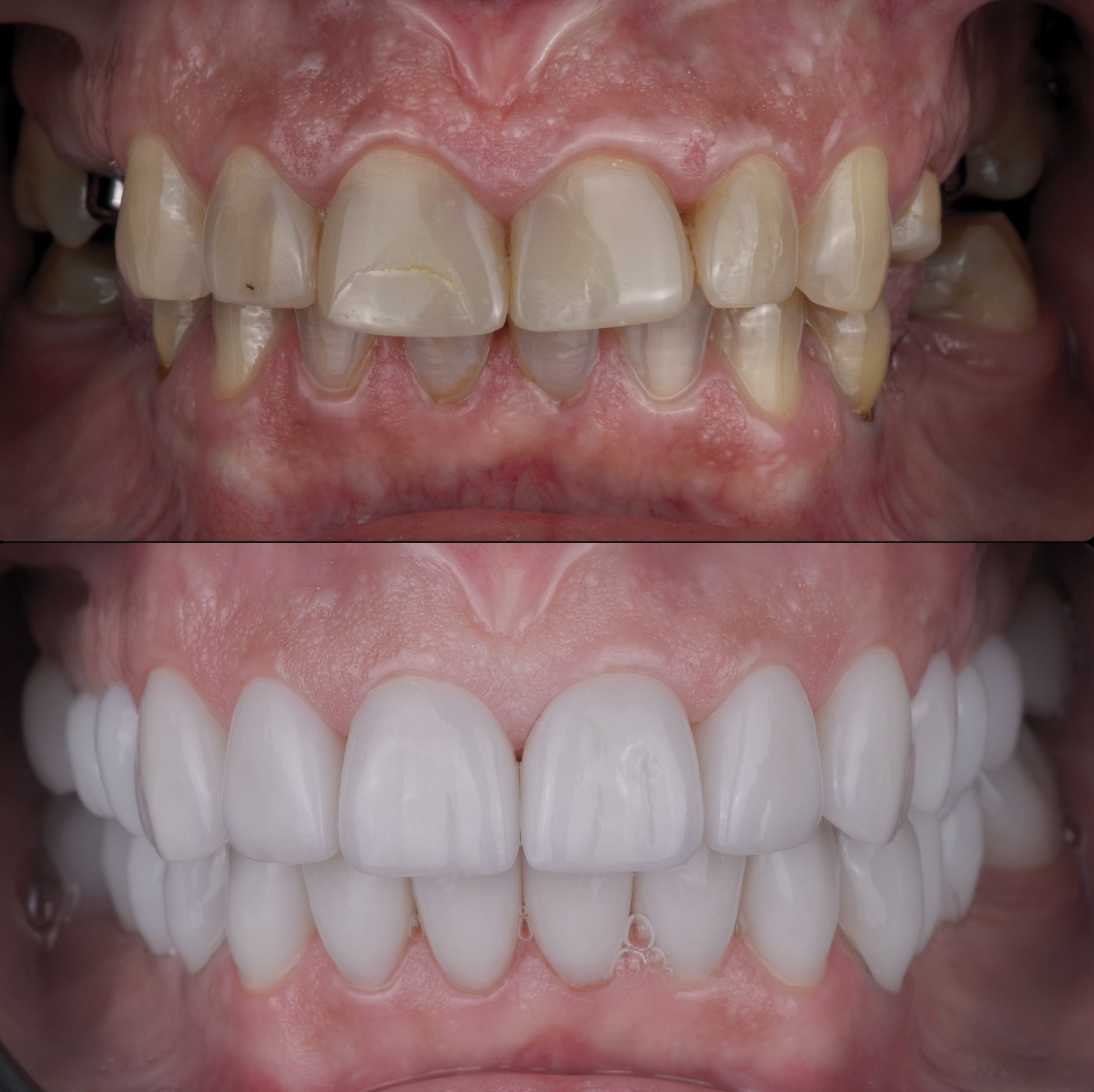 Тотальное протезирование (импланты, коронки, виниры)