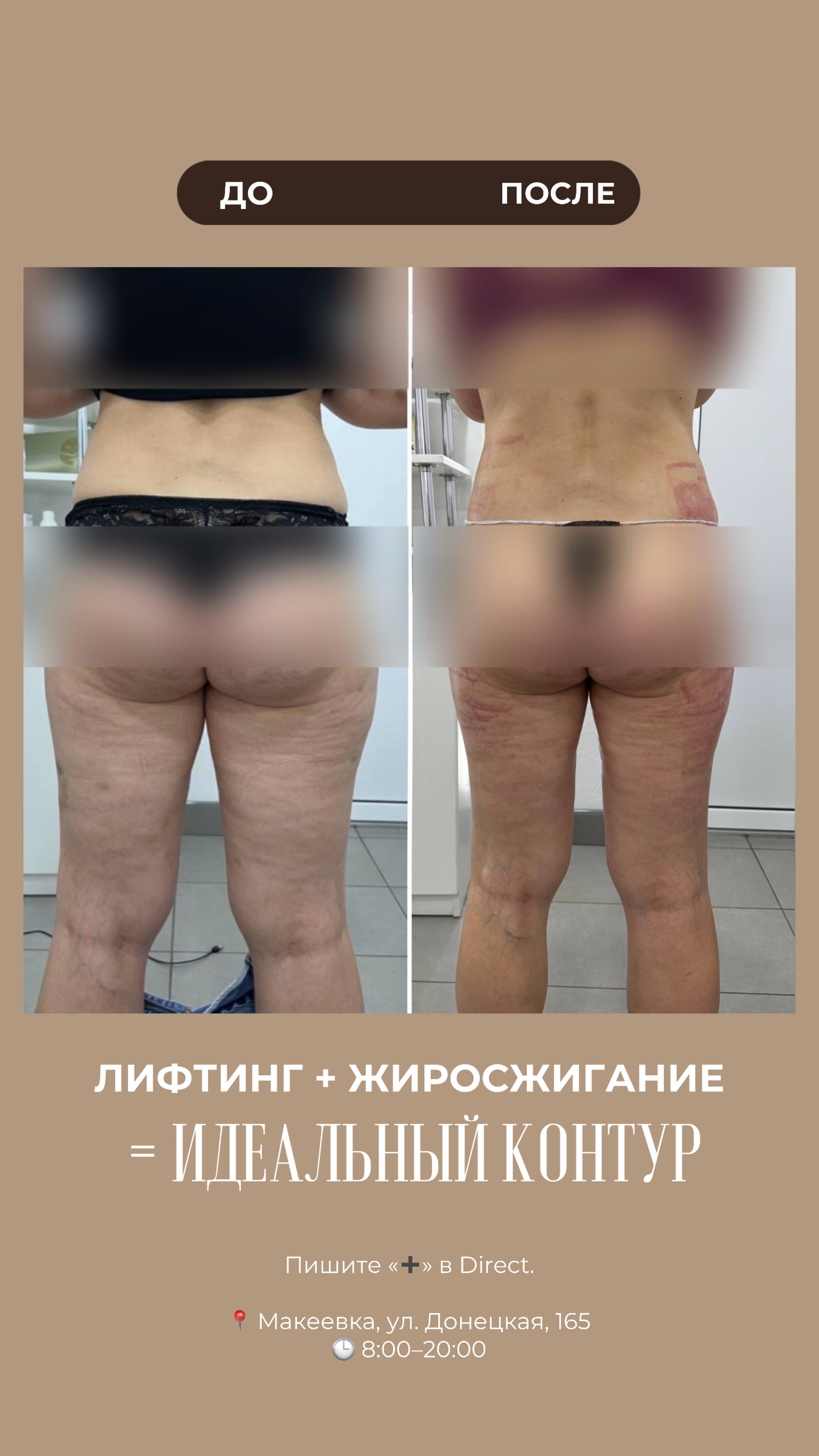РЕЗУЛЬТАТЫ КЛИЕНТОВ ДО/ПОСЛЕ. Центр аппаратной косметологии IVI