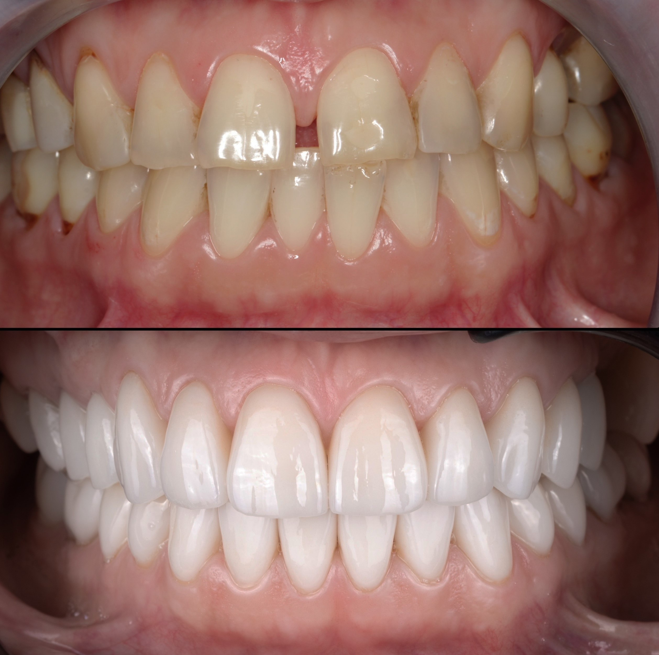 Создание улыбки мечты (виниры, коронки)