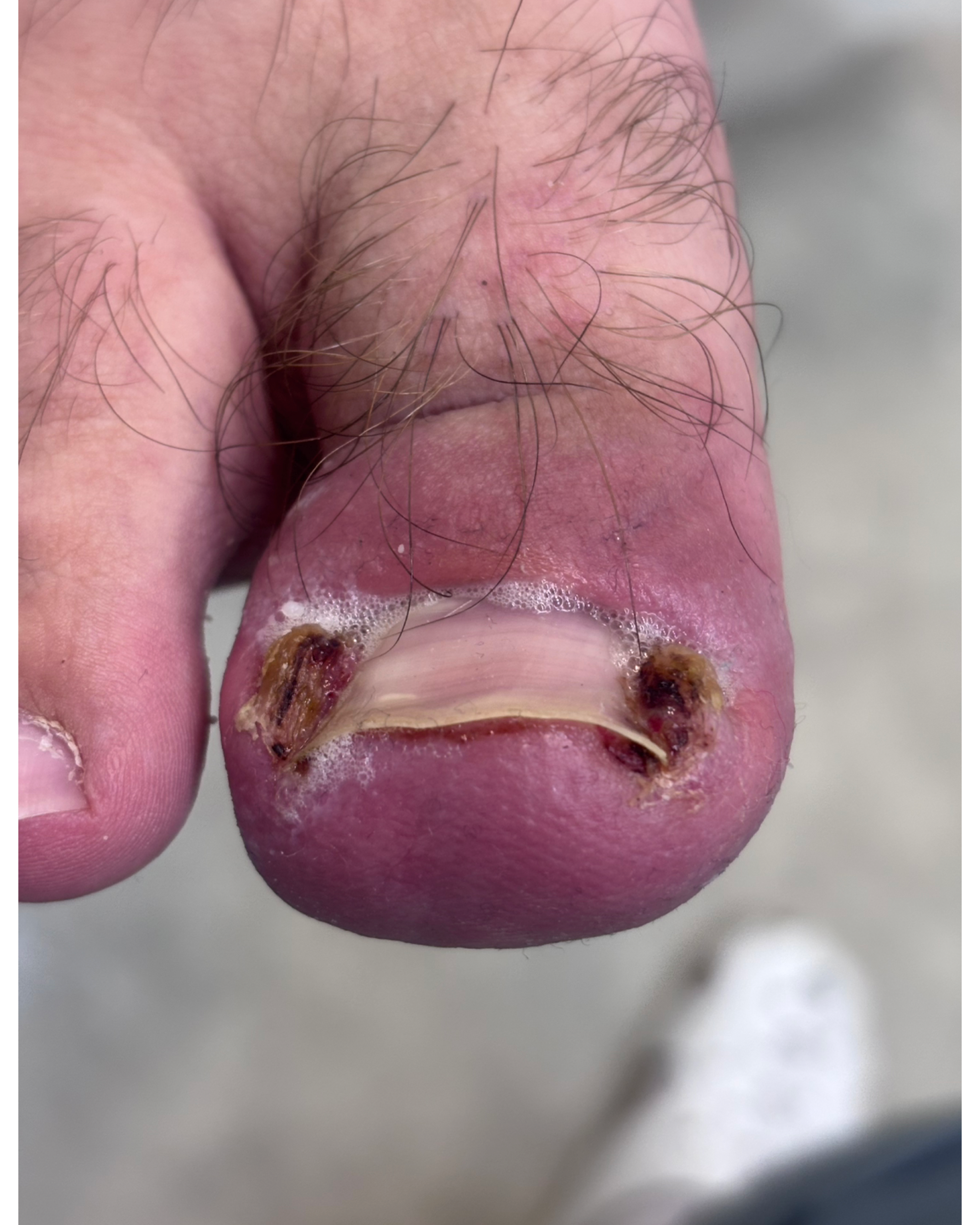 Вросший ноготь. Подолог г. Хабаровск — центр здоровой стопы «FOOTTIME»