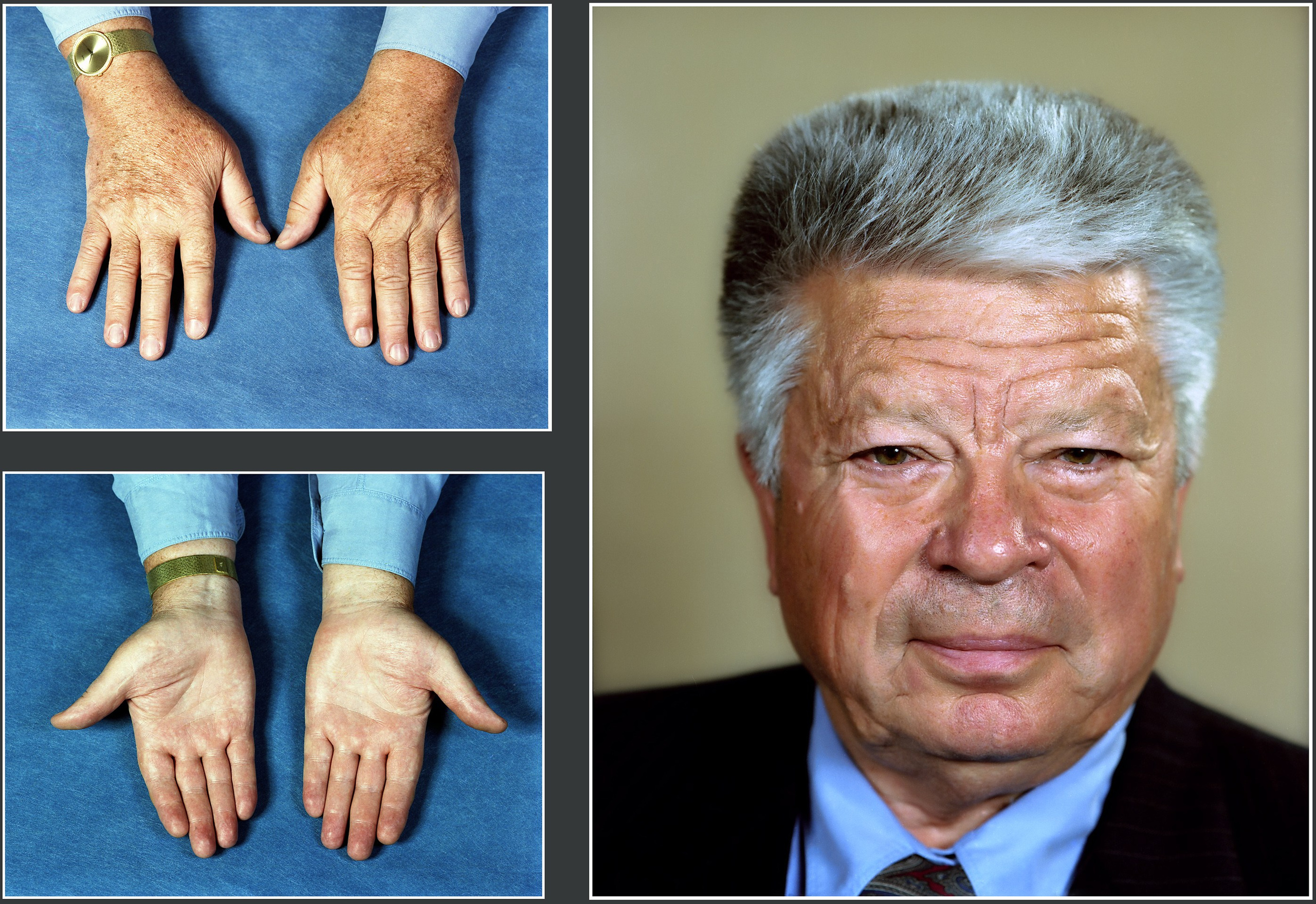 Портрет  хирурга Святослава Федорова, хирург и его руки. Глазной микрохирург.