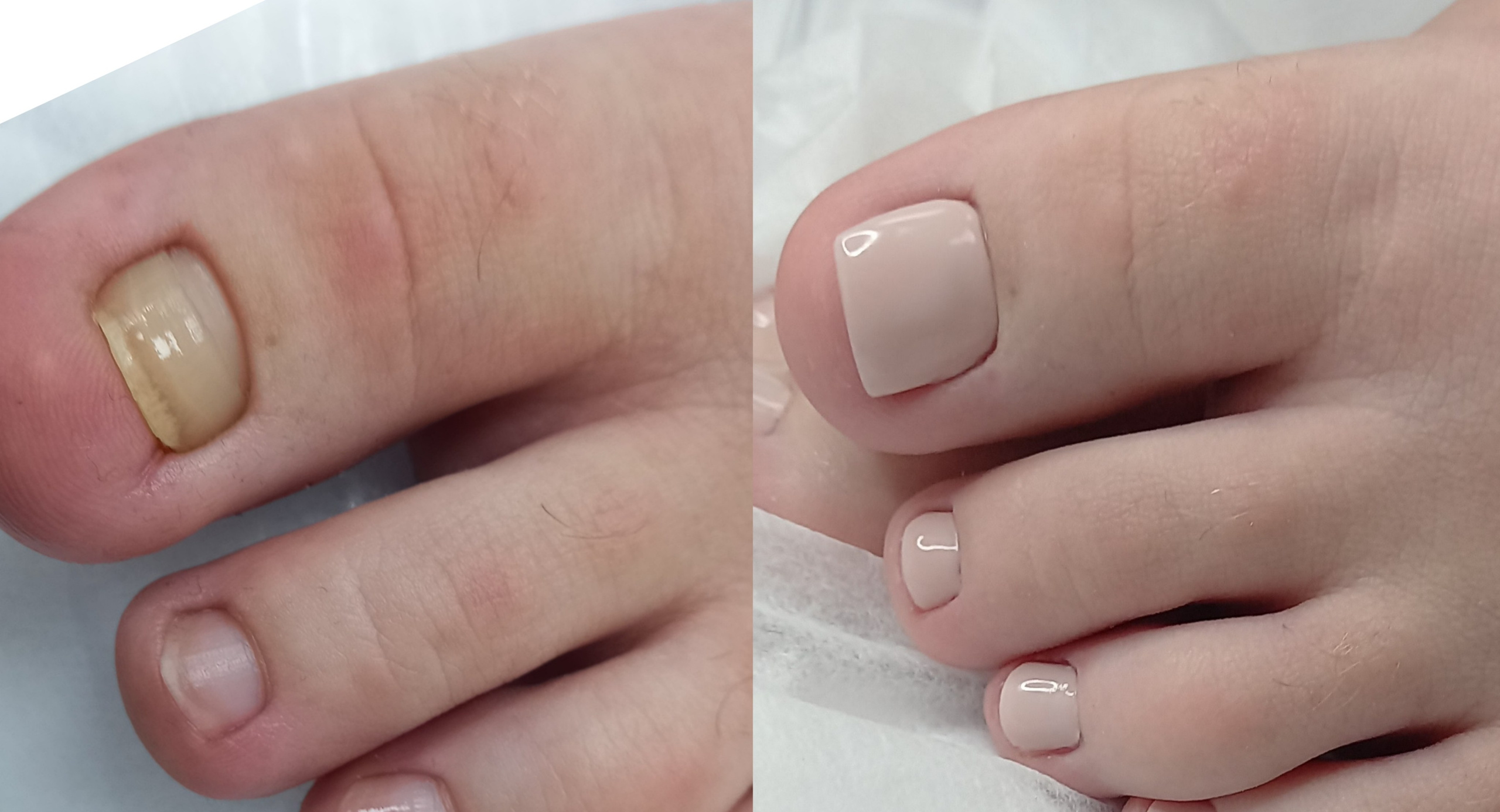 Протезирование ногтевой пластины. Подолог г. Хабаровск — центр здоровой стопы «FOOTTIME»