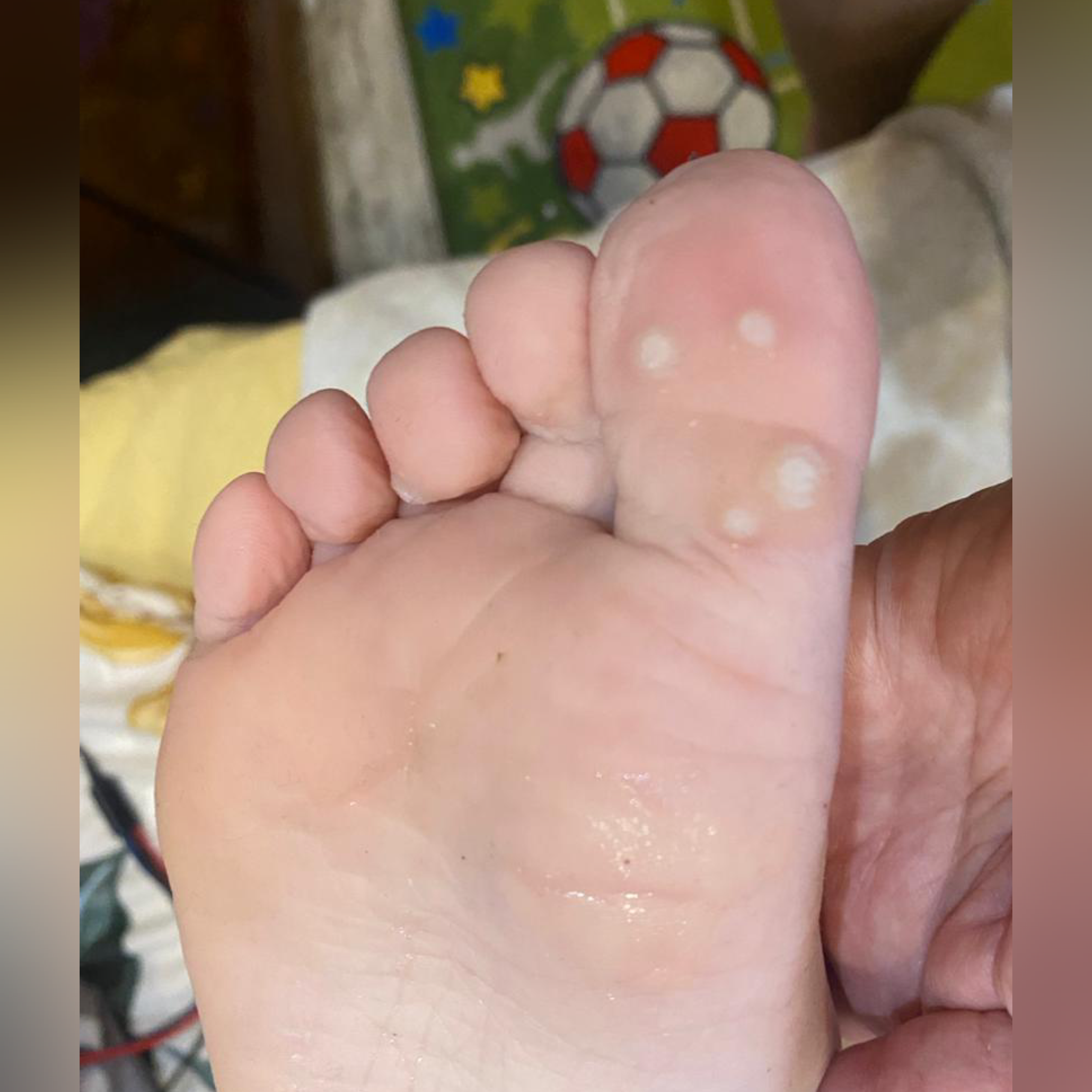 Обработка ВПЧ. Подолог г. Хабаровск — центр здоровой стопы «FOOTTIME»