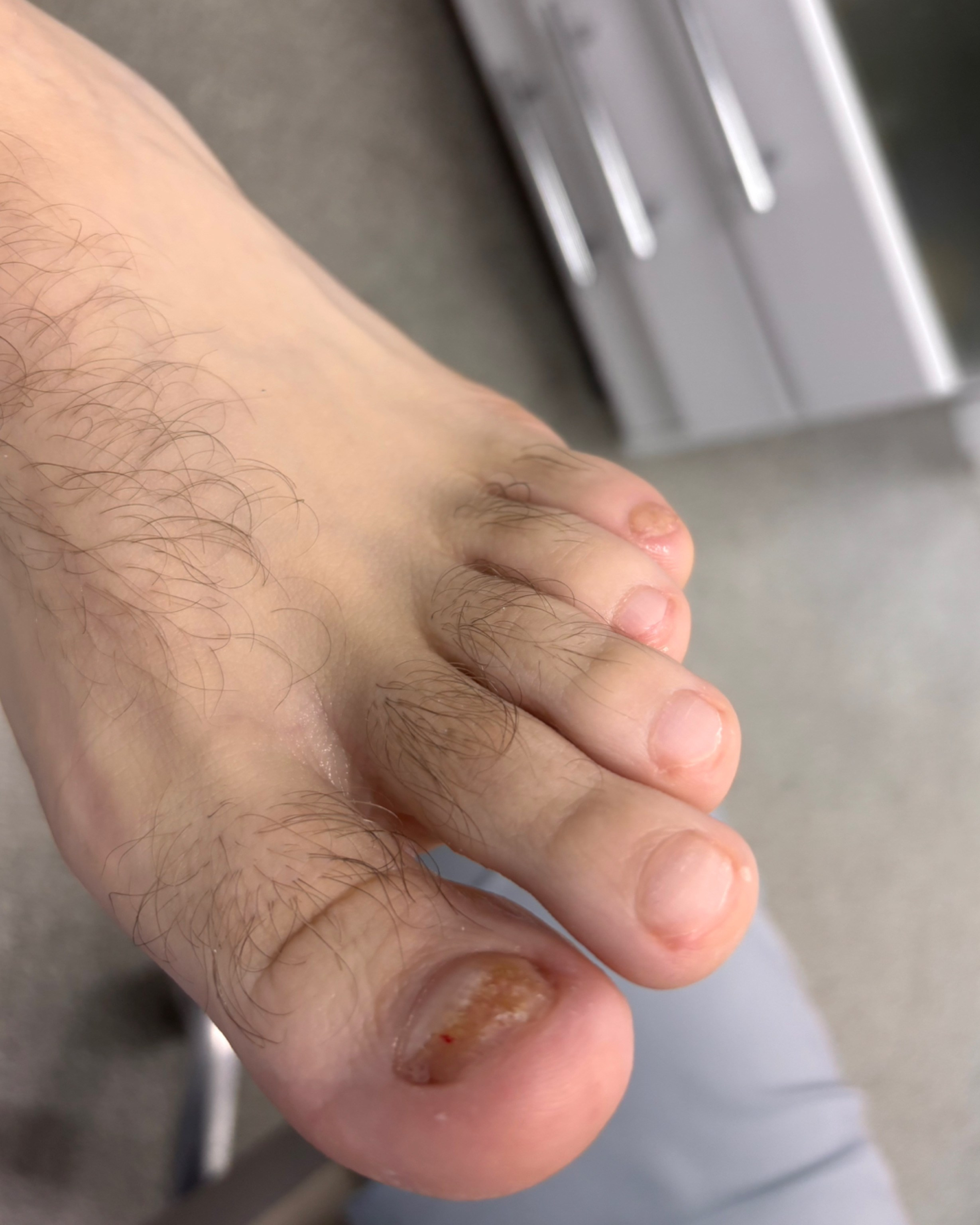 Обработка стопы при грибке. Подолог г. Хабаровск — центр здоровой стопы «FOOTTIME»