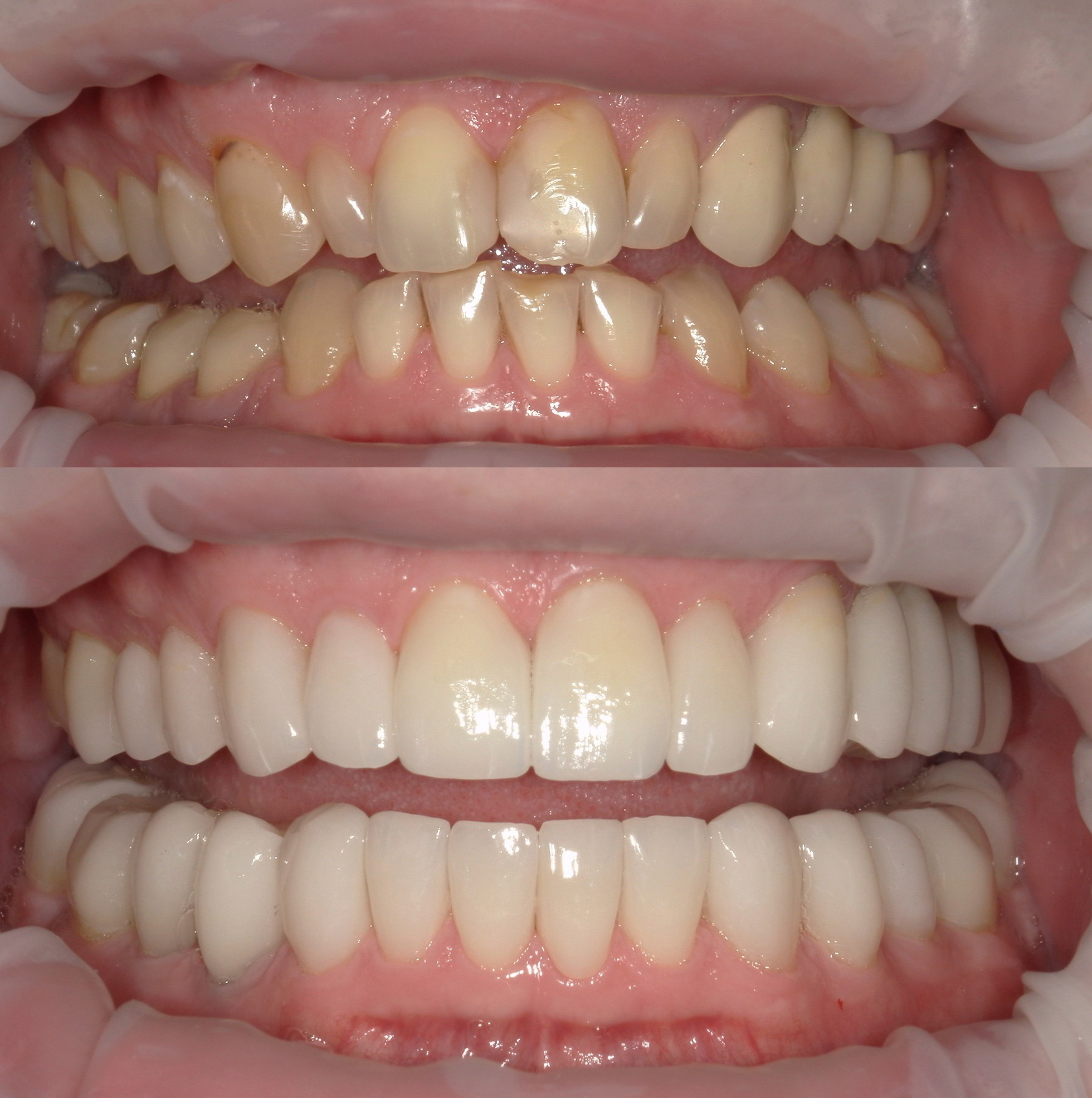 Протезирование винирами, коронками при стираемости зубов. Замена мостовидной конструкции на своих зубах на импланты.