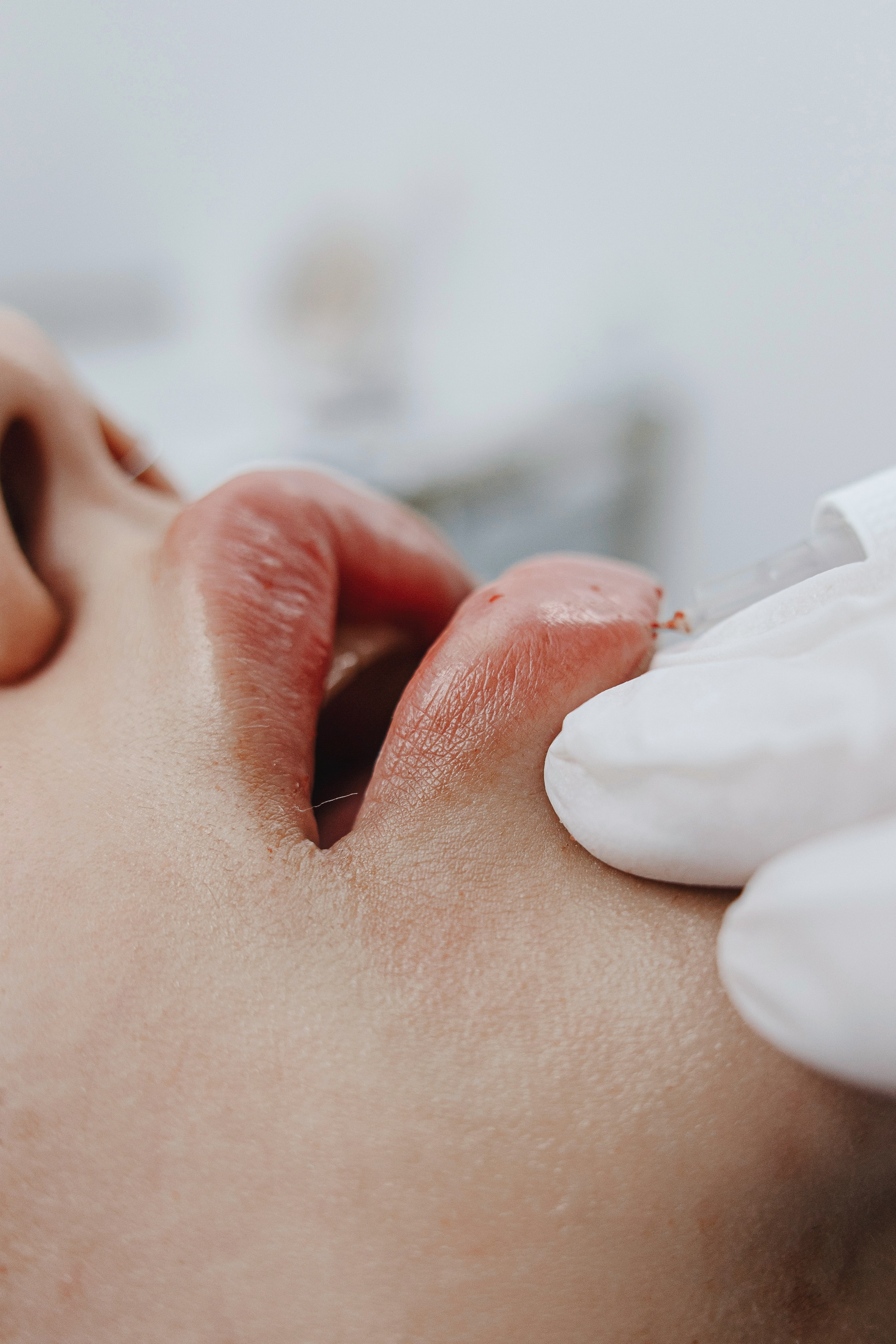 Процедура увеличения губ гиалуроновой кислотой, косметолог вводит препарат шприцем