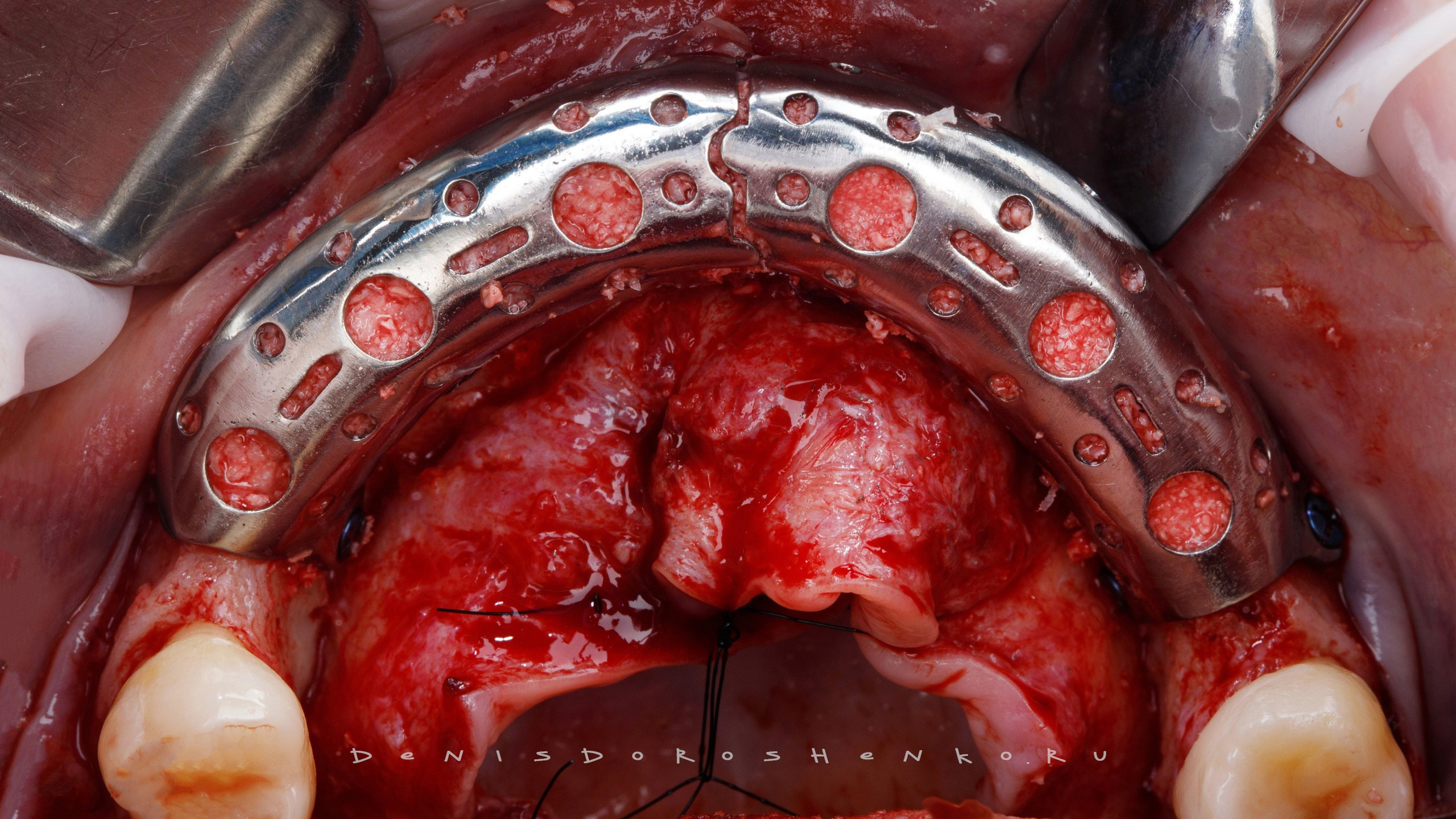 Хирургия. Дентал фотограф — видеограф Денис Дорошенко