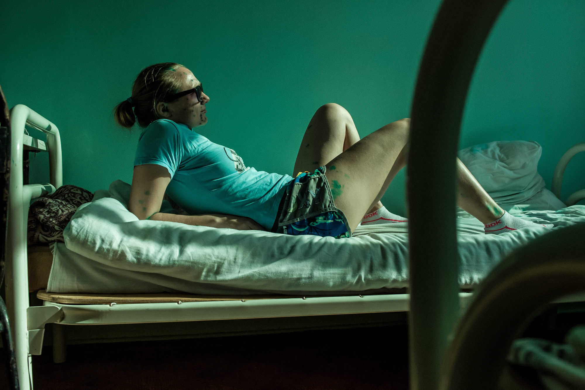 CHICKENPOX. Evgeniya Kokurina