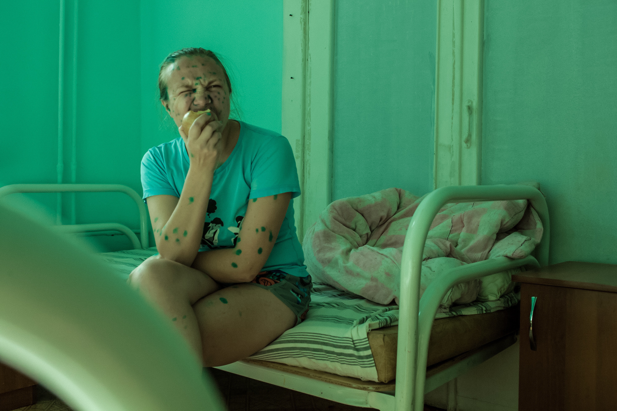 CHICKENPOX. Evgeniya Kokurina