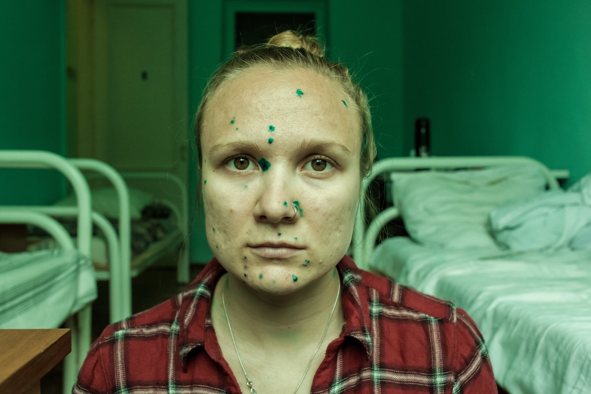 CHICKENPOX. Evgeniya Kokurina