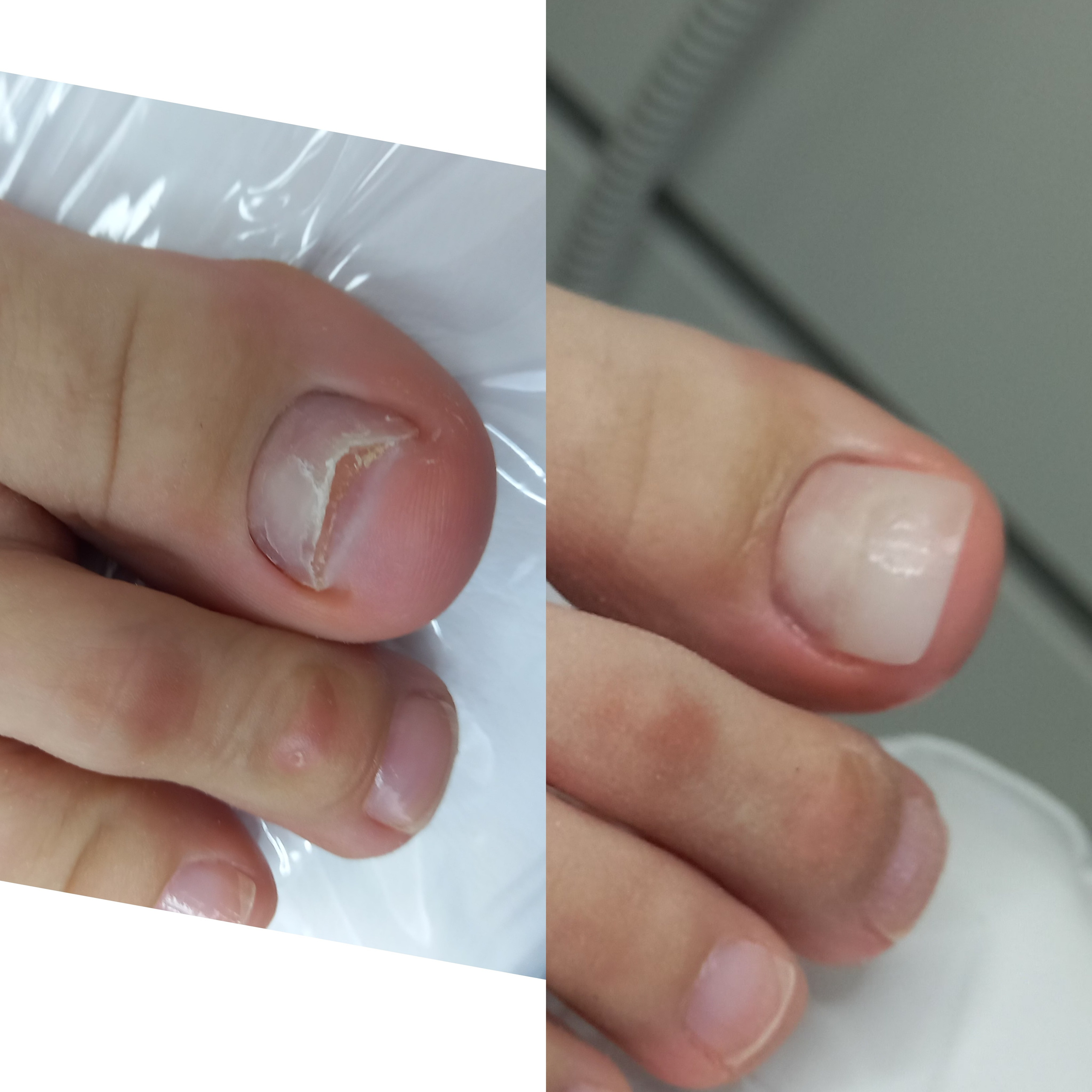 Протезирование ногтевой пластины. Подолог г. Хабаровск — центр здоровой стопы «FOOTTIME»