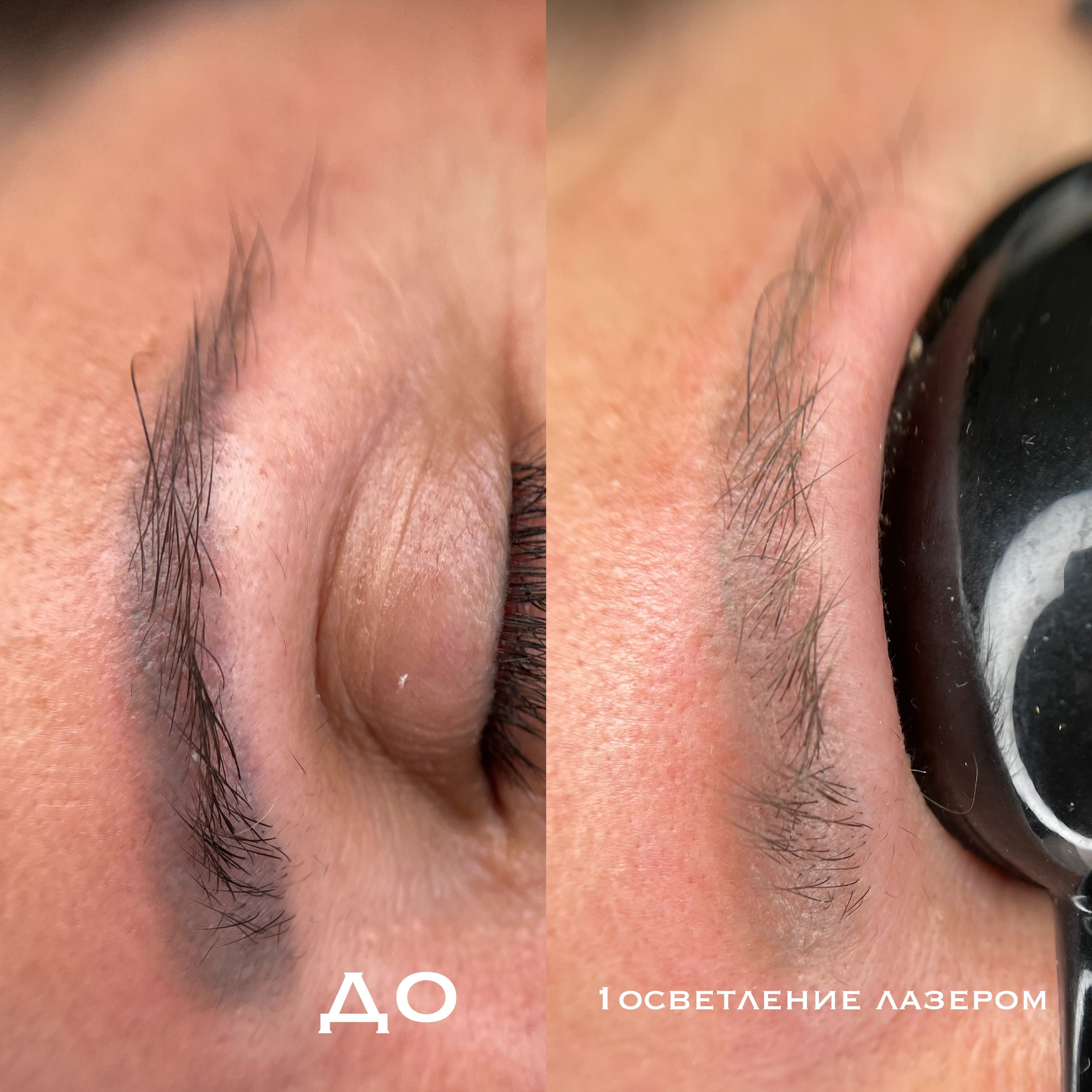 УДАЛЕНИЕ СТАРОГО ТАТУАЖА. Перманентный макияж и удаление старого татуажа в Ростове-на-Дону Дарья Исакова