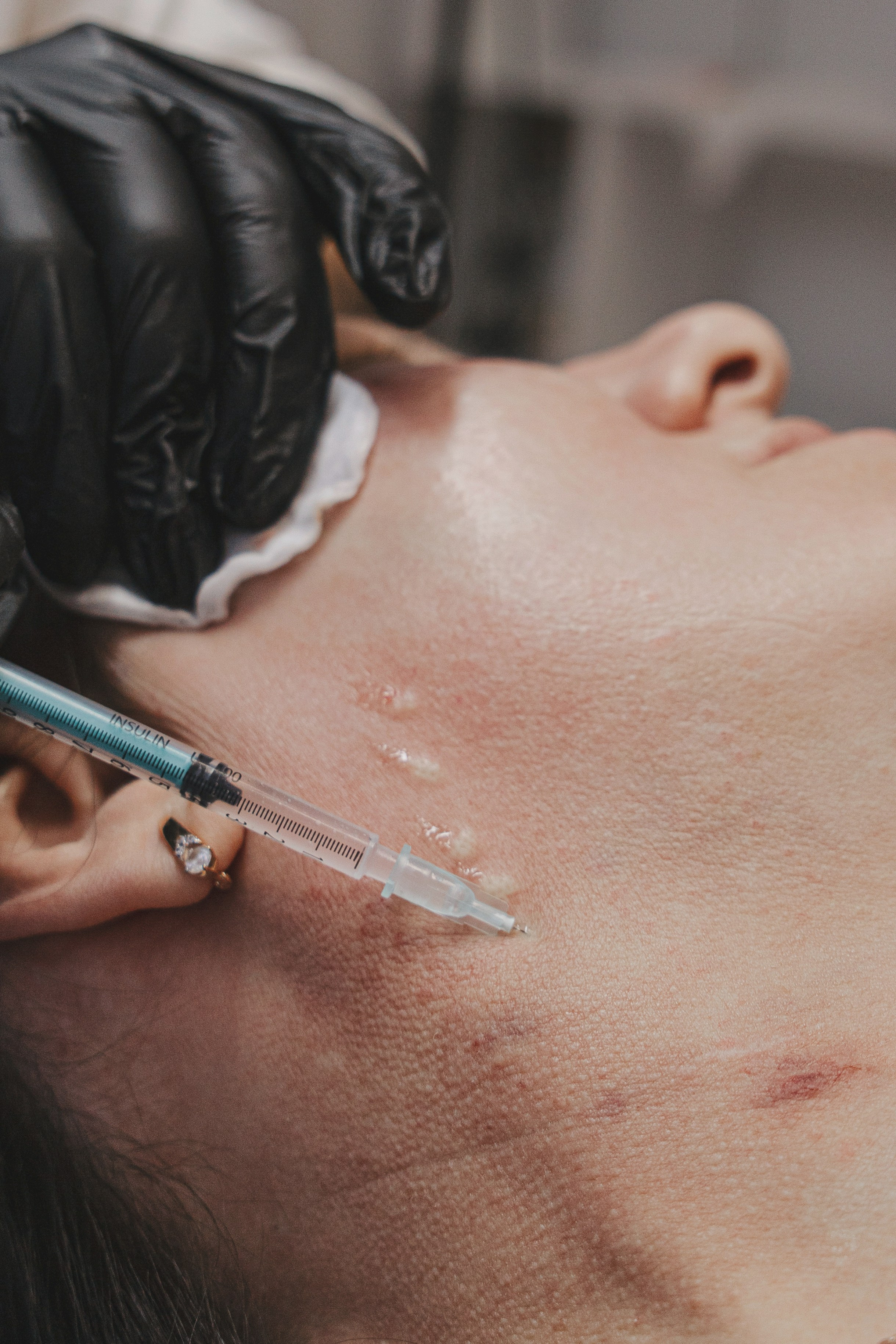 Косметолог вводит препарат под кожу лица, крупный план шприца и иглы