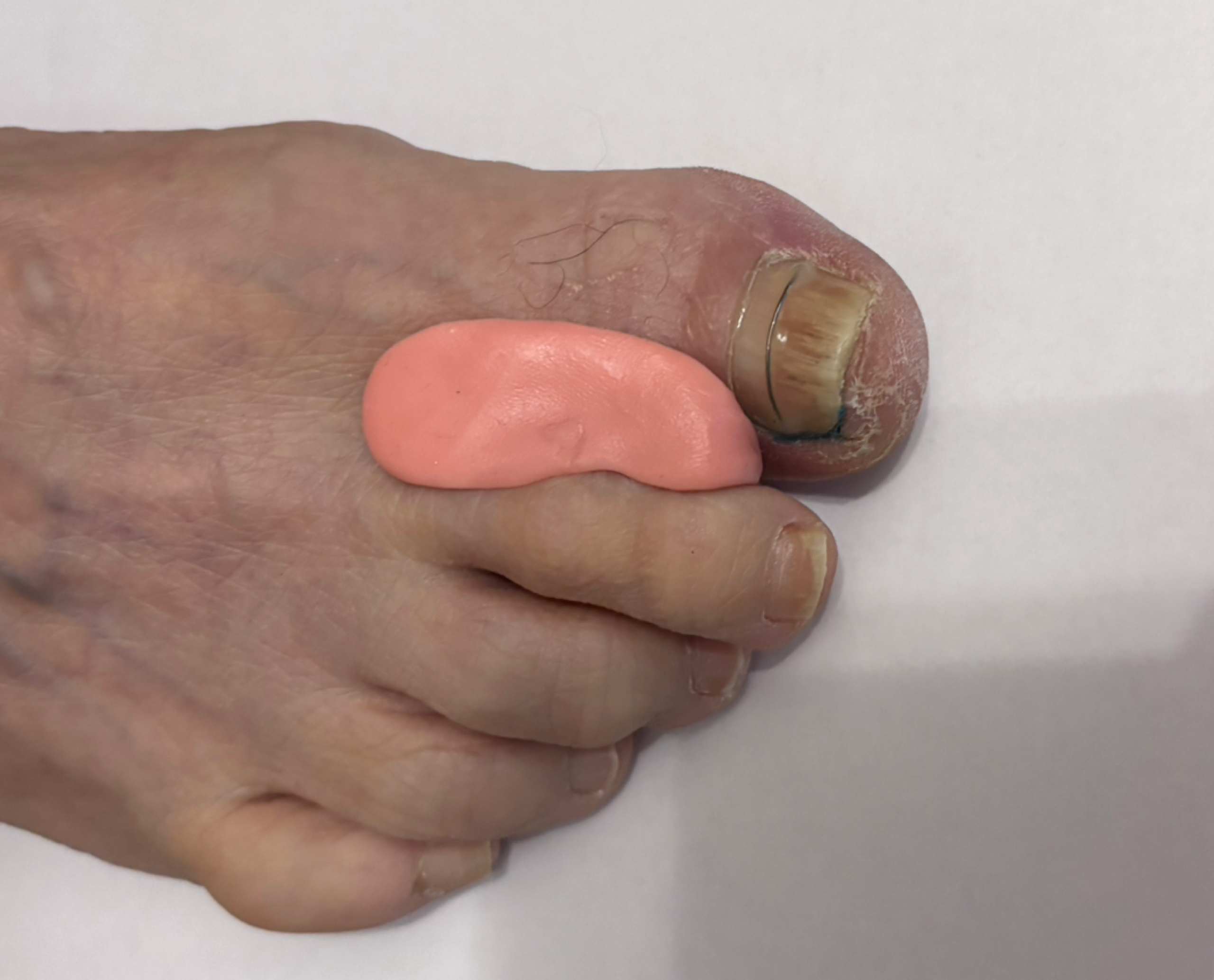 Изготовление индивидуального ортоза. Подолог г. Хабаровск — центр здоровой стопы «FOOTTIME»