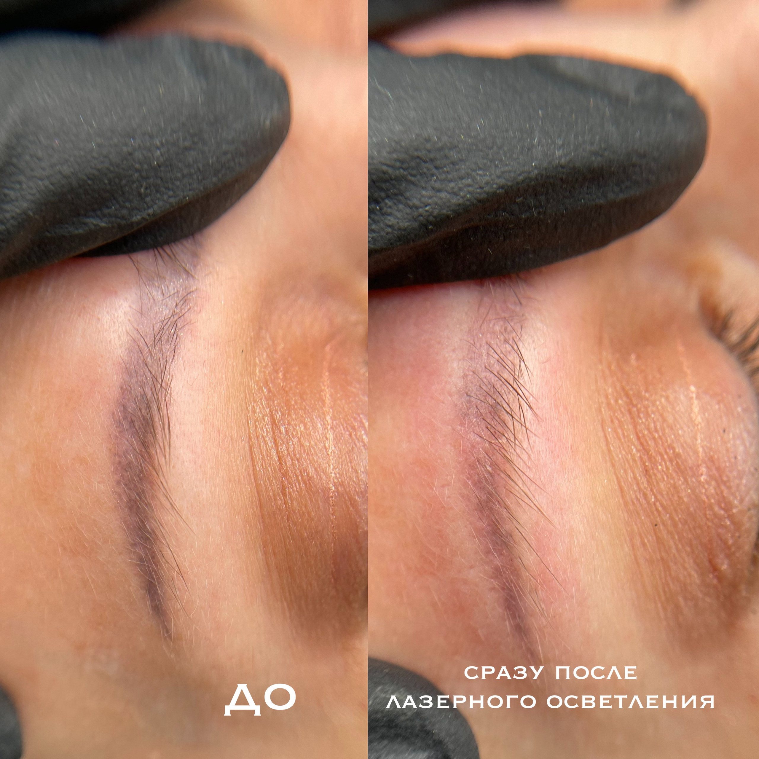 УДАЛЕНИЕ СТАРОГО ТАТУАЖА. Перманентный макияж и удаление старого татуажа в Ростове-на-Дону Дарья Исакова