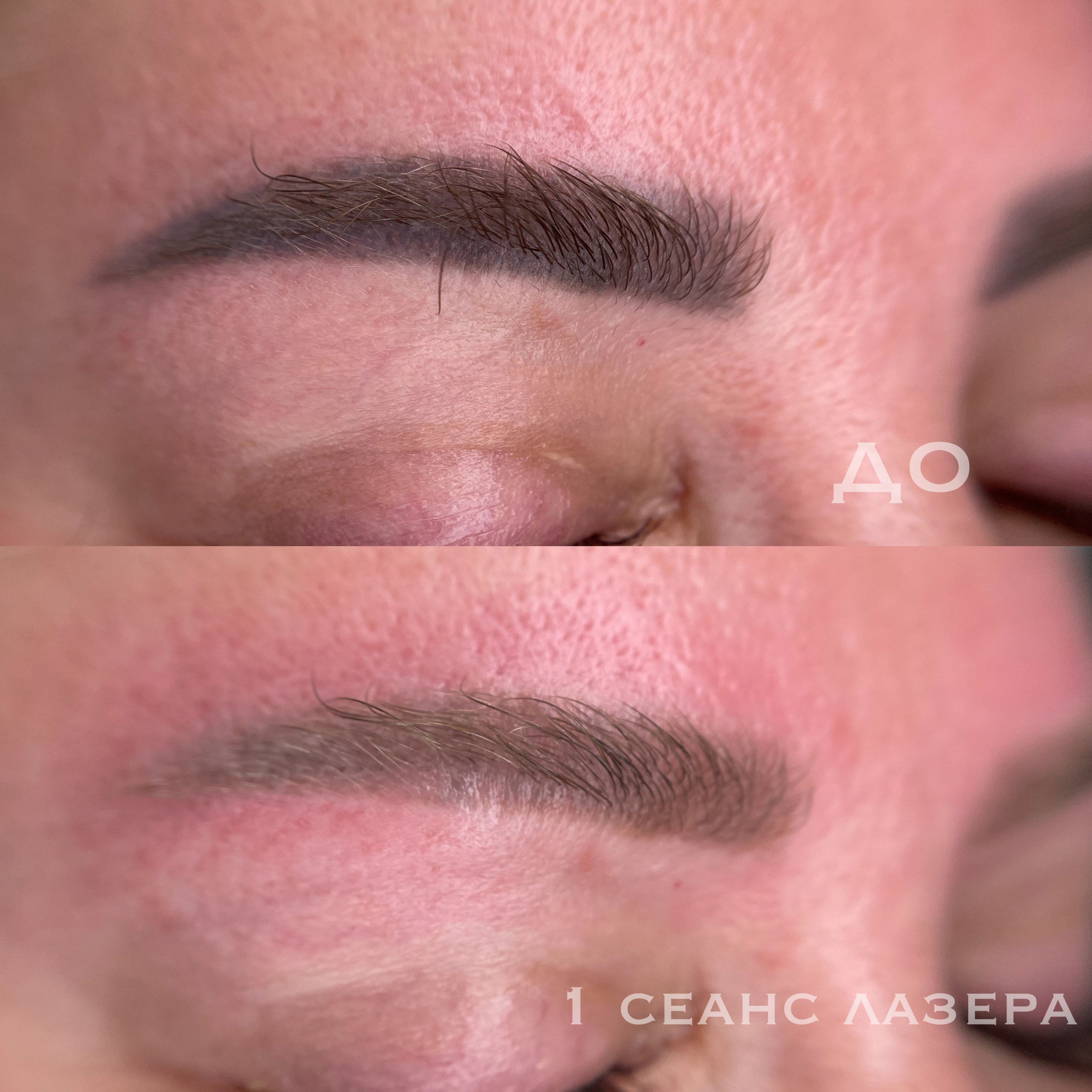 УДАЛЕНИЕ СТАРОГО ТАТУАЖА. Перманентный макияж и удаление старого татуажа в Ростове-на-Дону Дарья Исакова