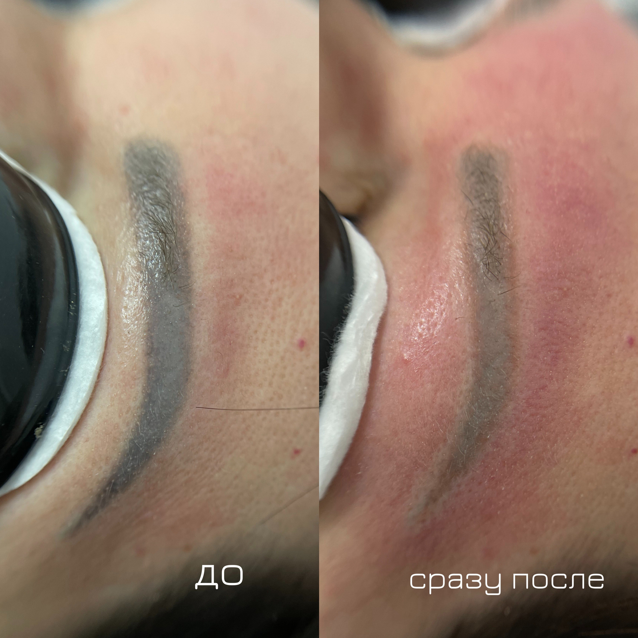 УДАЛЕНИЕ СТАРОГО ТАТУАЖА. Перманентный макияж и удаление старого татуажа в Ростове-на-Дону Дарья Исакова