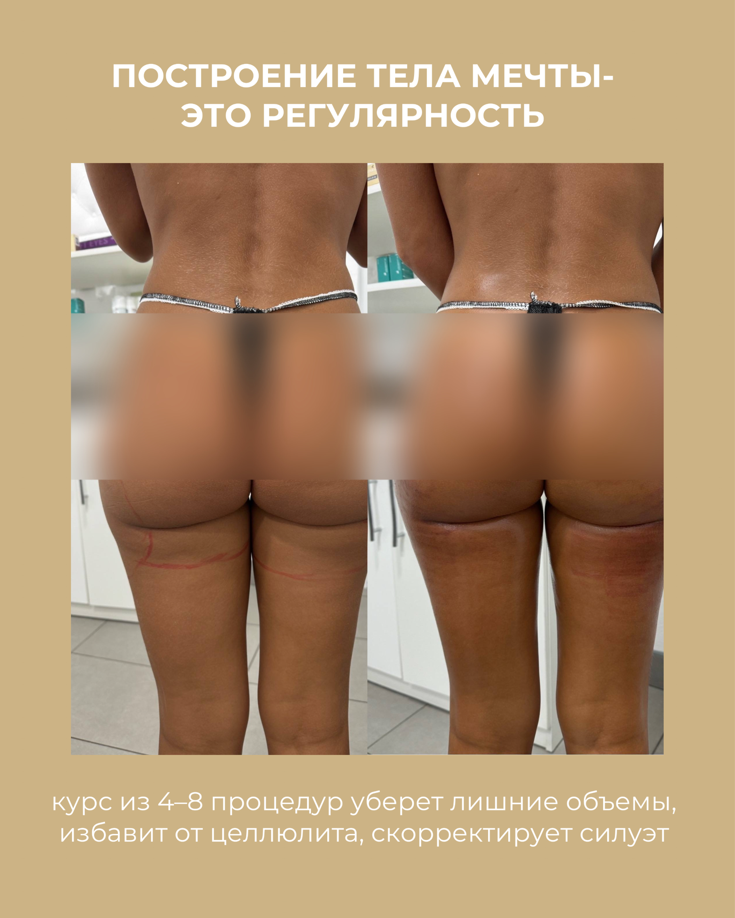 РЕЗУЛЬТАТЫ КЛИЕНТОВ ДО/ПОСЛЕ. Центр аппаратной косметологии IVI