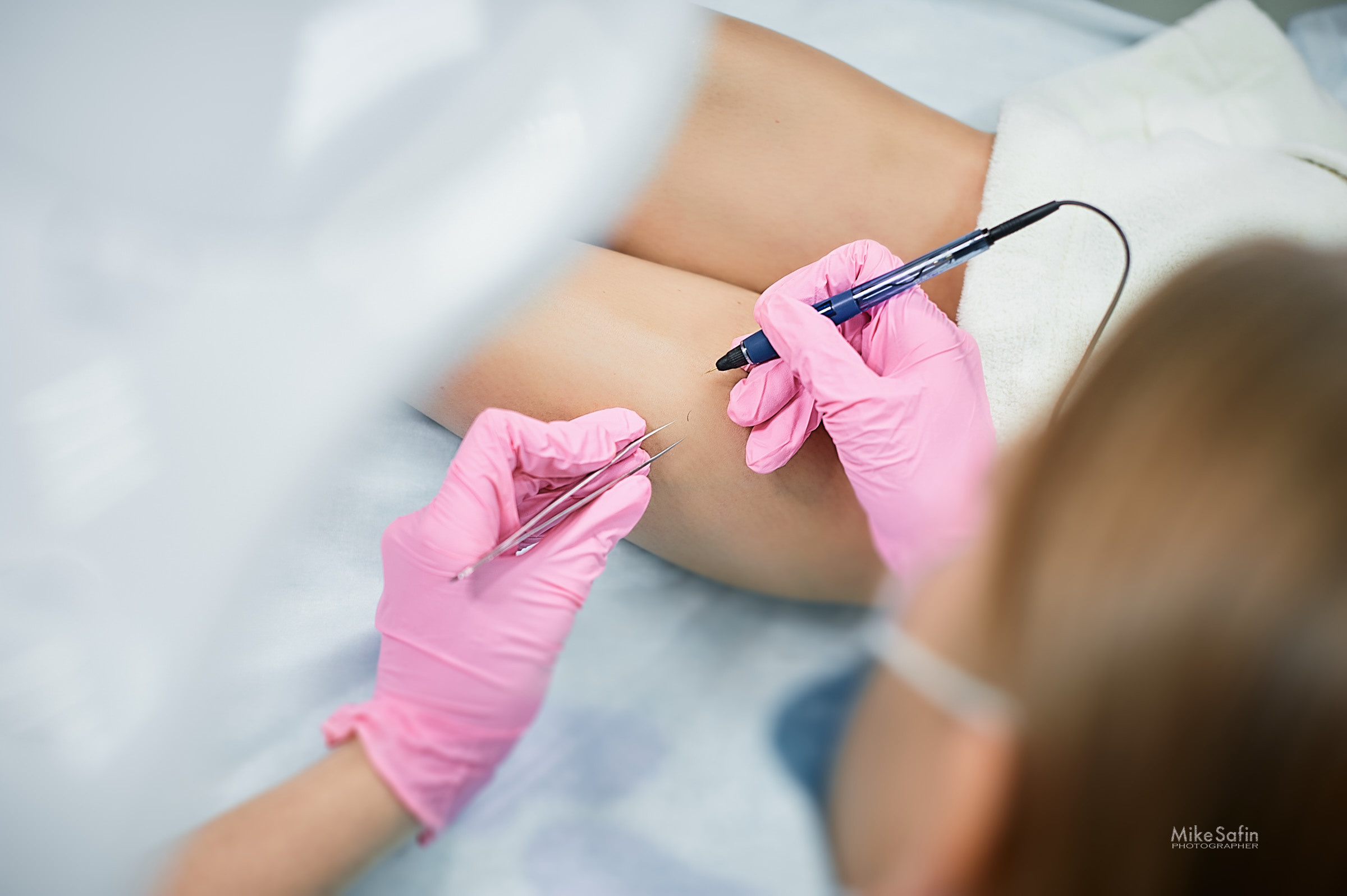 Электроэпиляция фотографии для постов, рекламы, бизнеса