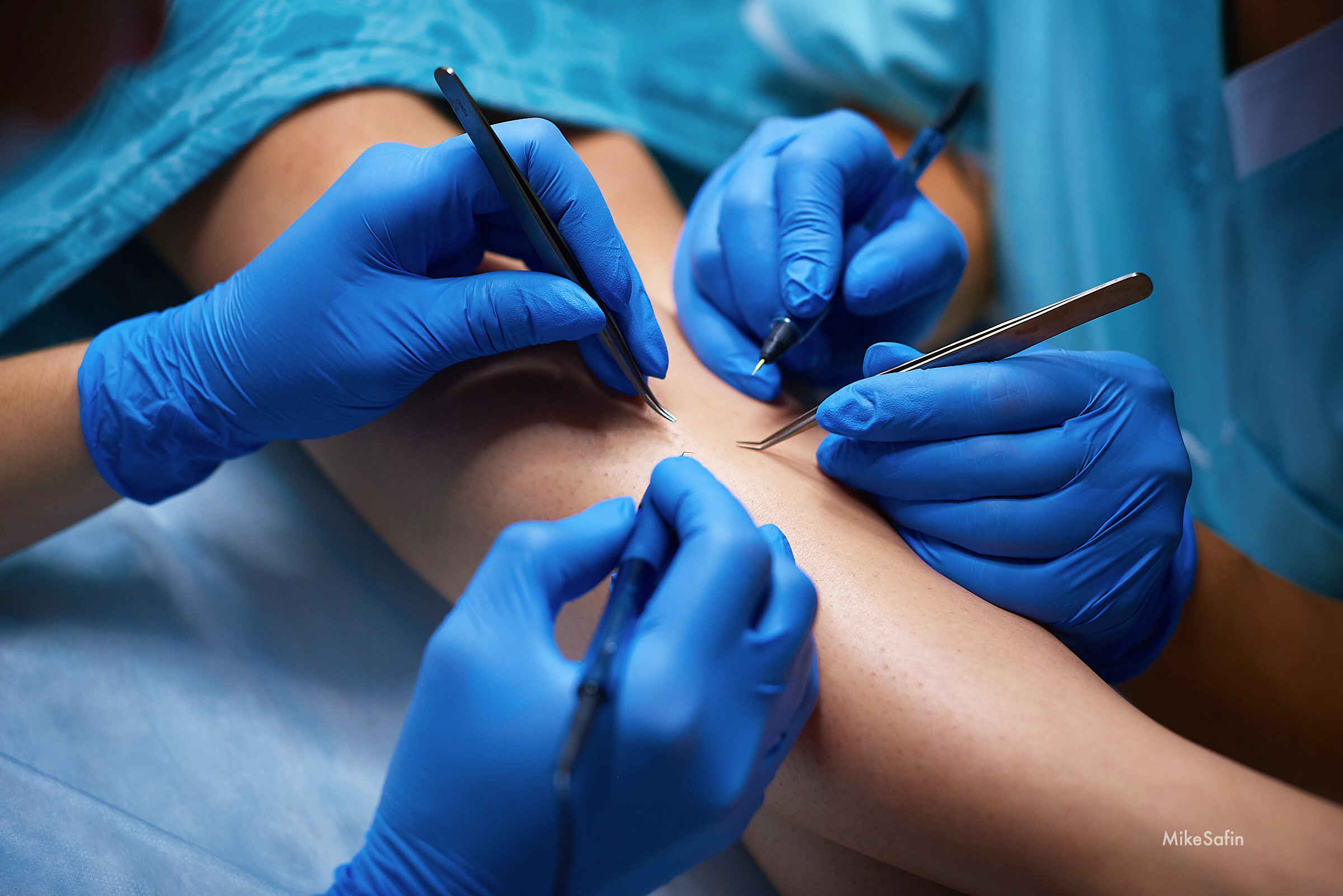 Электроэпиляция фотографии для постов, рекламы, бизнеса