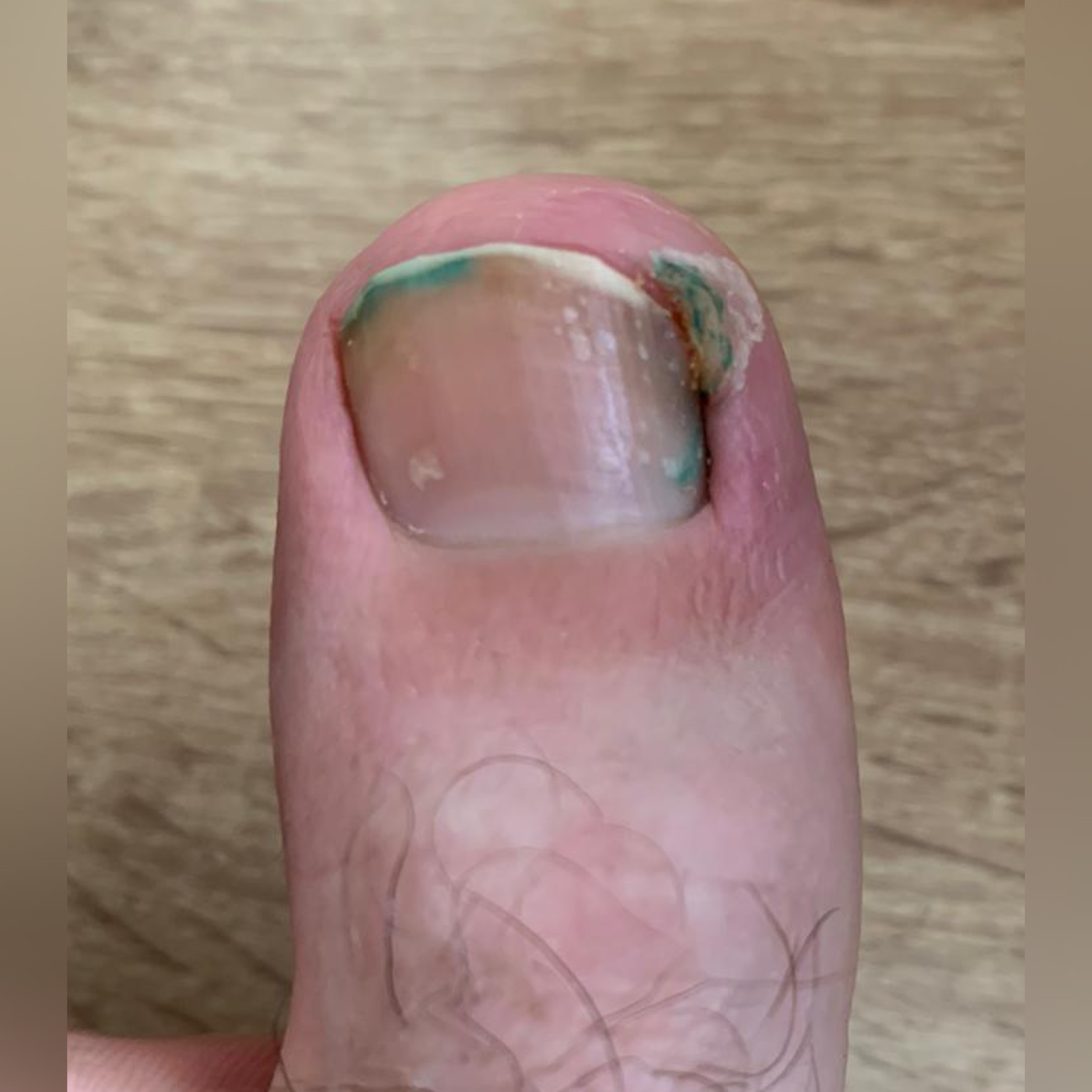 Решение проблемы вросшего ногтя. Подолог г. Хабаровск — центр здоровой стопы «FOOTTIME»