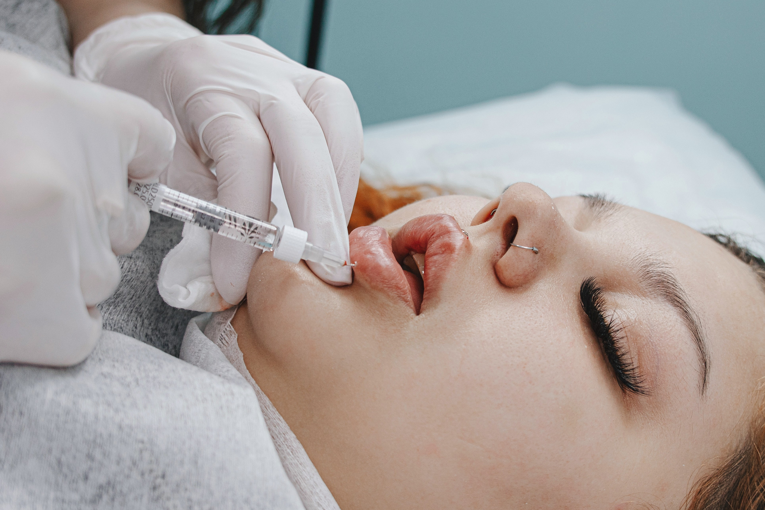 роцедура увеличения губ гиалуроновой кислотой, косметолог вводит препарат шприцем