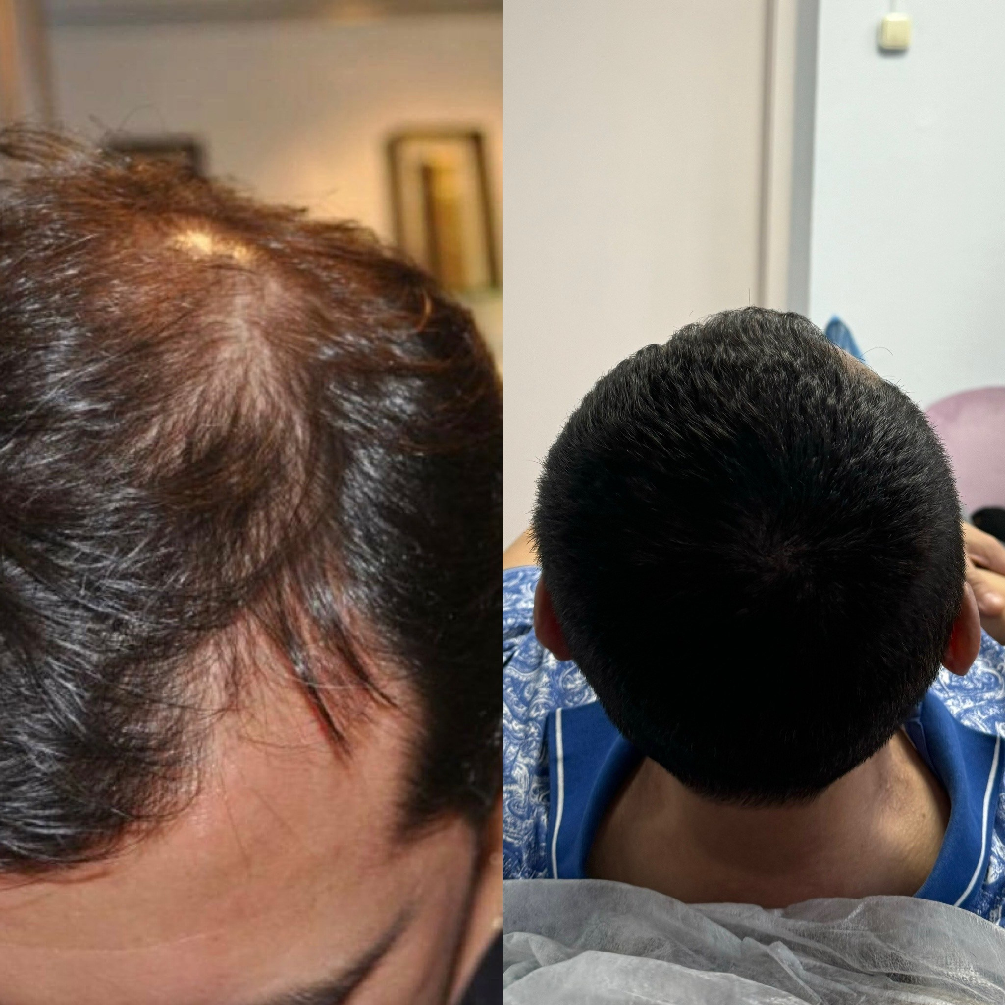 Нажмите на фото что бы открыть. SMP Трихопигментация Воронеж Волгоград Москва Казань Никита Нестеров