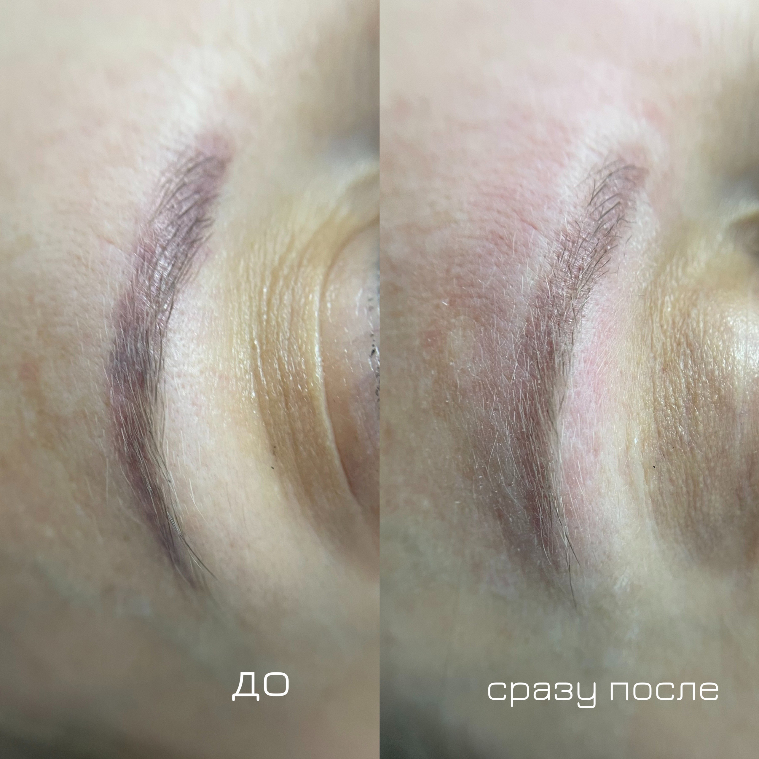 УДАЛЕНИЕ СТАРОГО ТАТУАЖА. Перманентный макияж и удаление старого татуажа в Ростове-на-Дону Дарья Исакова