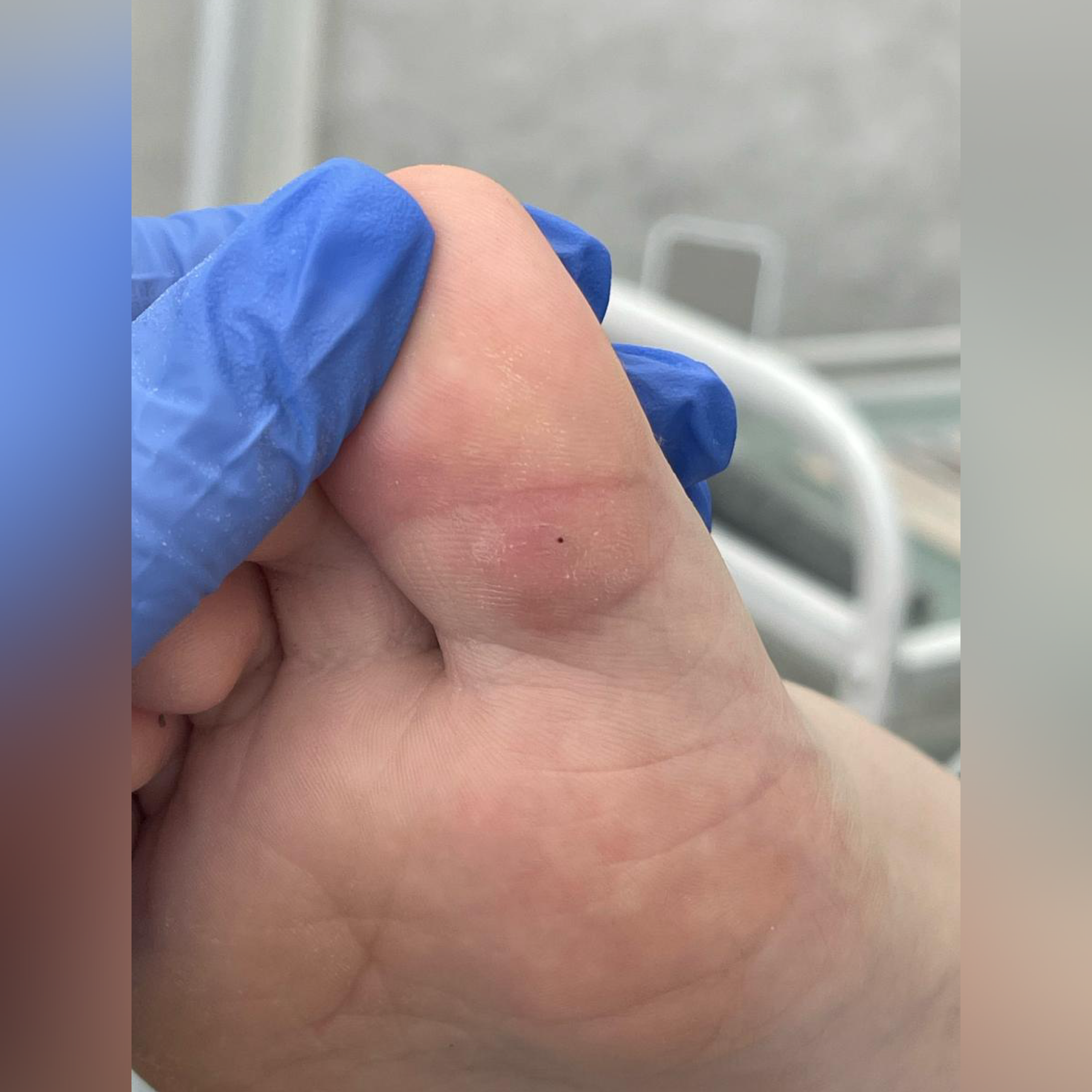 Обработка ВПЧ. Подолог г. Хабаровск — центр здоровой стопы «FOOTTIME»