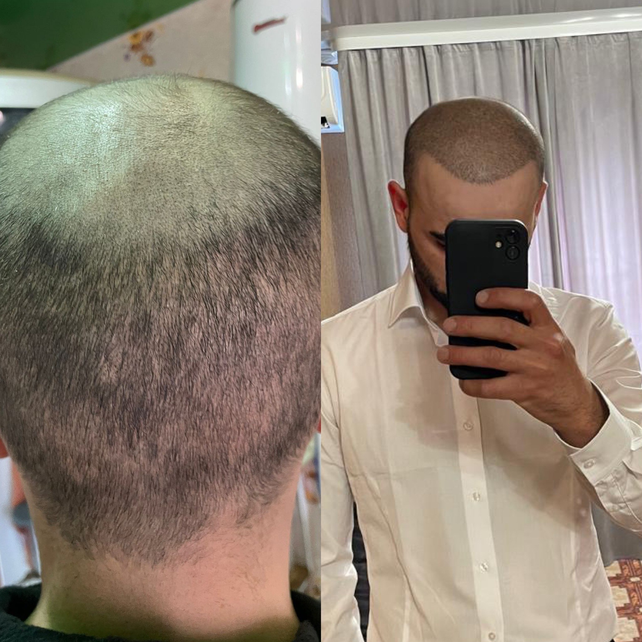 Нажмите на фото что бы открыть. SMP Трихопигментация Воронеж Волгоград Москва Казань Никита Нестеров