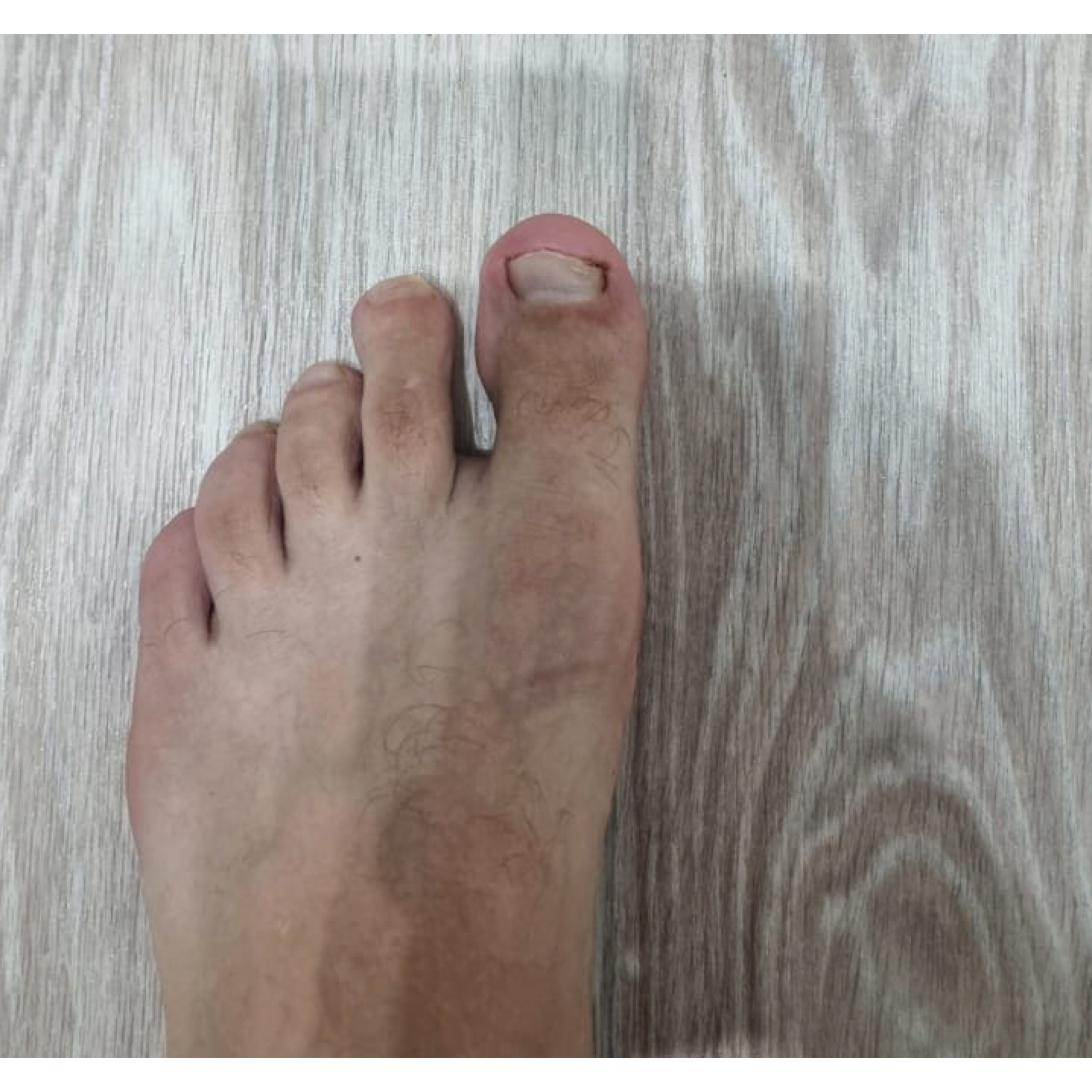 Динамика онихомикоз. Подолог г. Хабаровск — центр здоровой стопы «FOOTTIME»